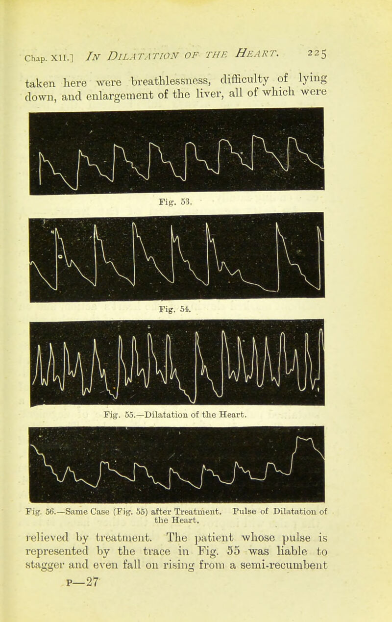 taken here were breathlessness, difficulty of lying down, and enlargement of the liver, all of which were Fig. 55.—Dilatation of the Heart. Fig. 56.—Same Case (Fig. 55) after Treatment. Pulse of Dilatation of the Heart. relieved by treatment. The patient whose pulse is represented by the trace in Fig. 55 was liable to stagger and even fall on rising from a semi-recumbent p—27