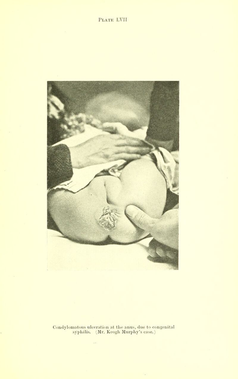 Condylomatous ulceration at the anus, due to congenital syphilis. '^Mr. Keogh Murphy's case.)
