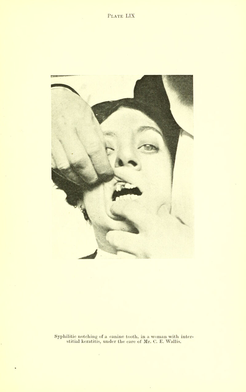 Syphilitic notching of a canine tooth, in a woman witli inter- stitial keratitis, under the care of Mr. C. E. Wallis.
