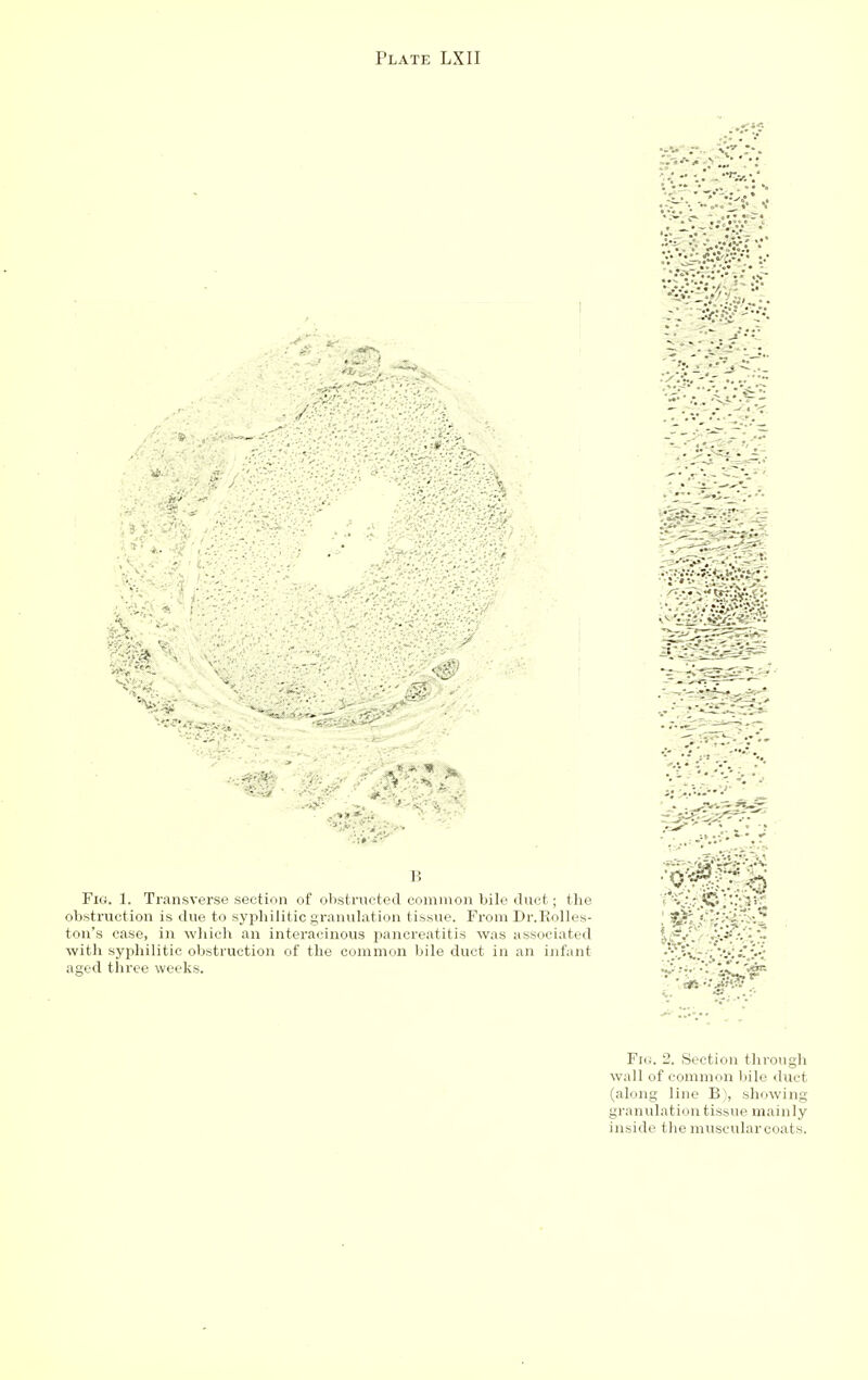 B Fig. 1. Transverse section of obstructed common bile <lnct; tlie obstruction is due to sypliilitic granulation tissue. From Dr.Kolles- ton's case, in which an interacinous pancreatitis was associated with syphilitic obstruction of the common bile duct in an infant aged three weeks. Fig. 2. Section through wall of common bile duet (along line B), showing granulation tissue mainly inside the muscular coats.