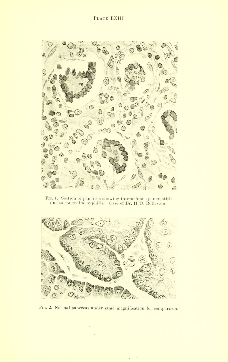 Fig. 1. Section of i^ancreas showing interacinous pancreatitis due to congenital sypliilis. Case of Dr. H. D. Kolleston. Fig. 2. Normal pancreas under same magnification for comparison.