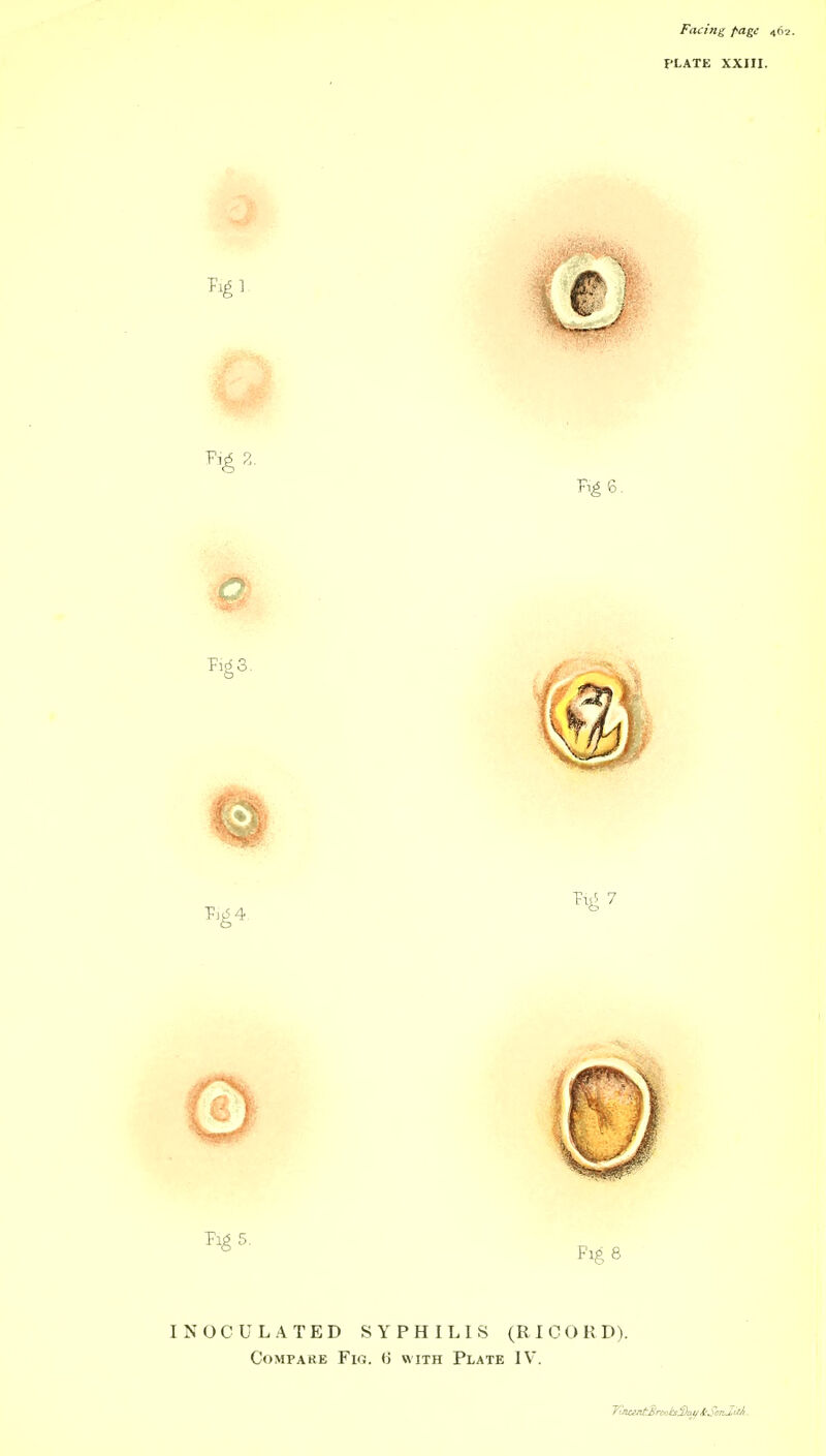 PLATE XXIII. INOCULATED SYPHILIS (RI C O K D).