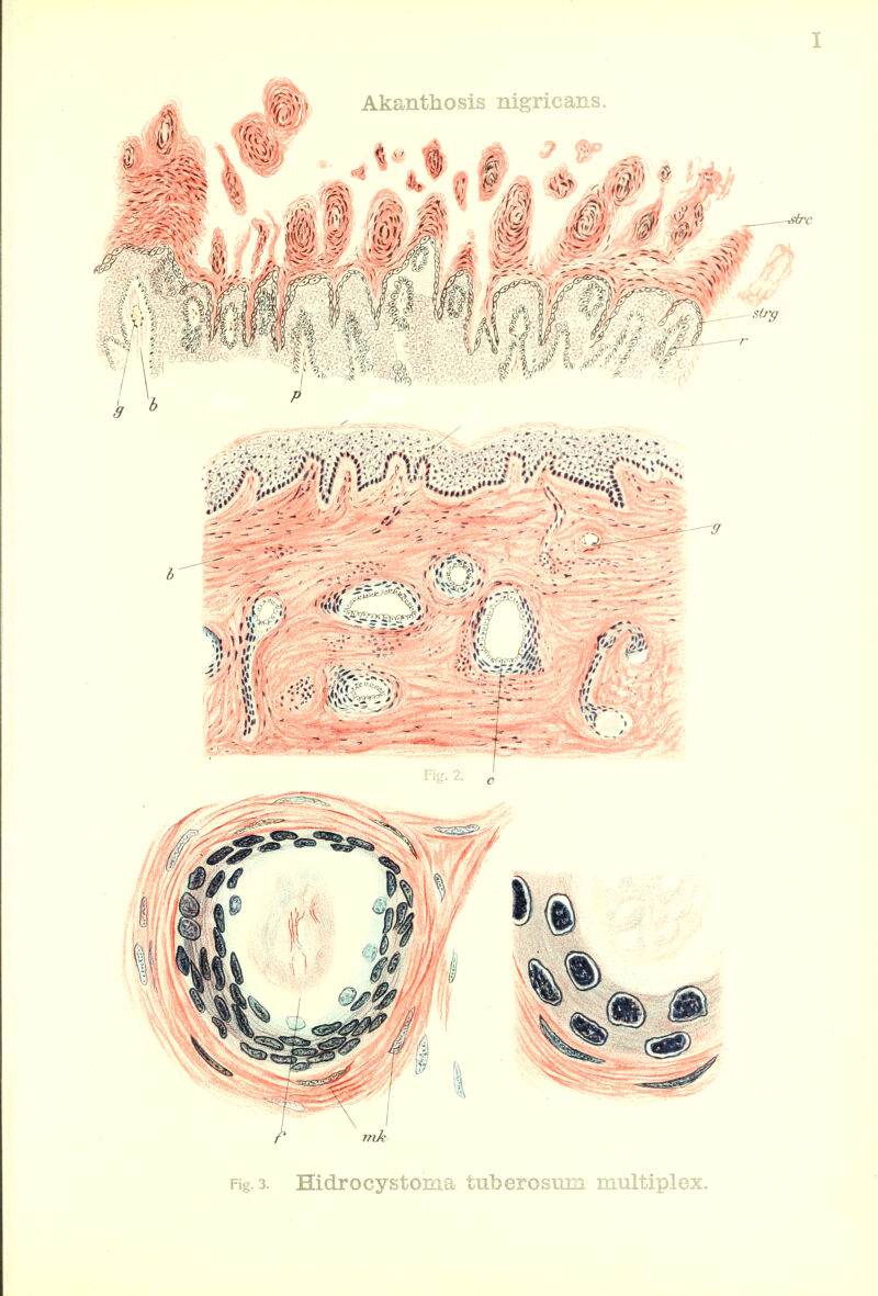 Fig. 3. Hidrocystoma tu.berosun3 multiplex.