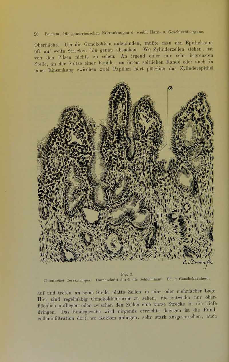 Oberfläche. Um die Gonokokken aufzufinden, mußte man den Epithelsaum oft auf weite Strecken hin genau absuchen. Wo Zylinderzellen stehen, ist von den Pilzen nichts zu sehen. An irgend einer nur sehr begrenzten Stelle an der Spitze einer Papille, an ihrem seitlichen Rande oder auch in einer Einsenkung zwischen zwei Papillen hört plötzlich das Zylinderepithel Fig. 2. Chronischer Cervixtripper. Durchschnitt durch die Sclilcimhaut. Bei a Gonokokkenherd. auf und treten an seine Stelle platte Zellen in ein- oder mehrfacher Lage. Hier sind regelmäßig Gonokokkenrasen zu sehen, die entweder nur ober- flächlich aufliegen oder zwischen den Zellen eine kurze Strecke in die Tiefe dringen. Das Bindegewebe wird nirgends erreicht; dagegen ist die Eund- zelleninfiltration dort, wo Kokken anliegen, sehr stark ausgesprochen, auch
