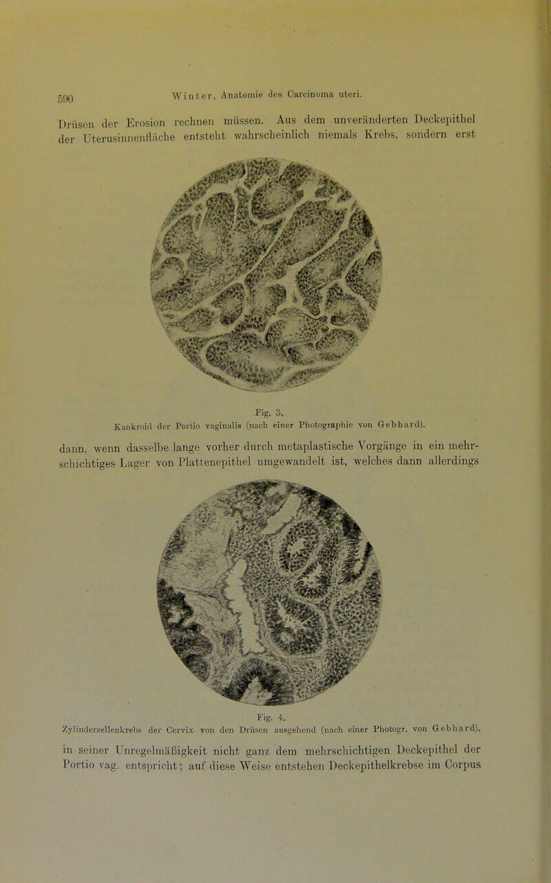 Drüsen der Erosion rechnen müssen. Aus dem unveränderten Deckepithel der Uterusinnenfläche entsteht wahrscheinlich niemals Krebs, sondern erst rig. 3. Kaukroid der Portio vaginalis (nach einer Pliotographie von Gebhard). dann, wenn dasselbe lange vorher durch metaplastische Vorgänge in ein mehr- schichtiges Lager von Plattenepithel umgewandelt ist, welches dann allerdings Fig. 4. Zylinderzellenkrebs der Cervix- von den Drüsen ausgehend (nach einer Photogr. von Gebhard). in seiner Unregelmäßigkeit nicht ganz dem mehrschichtigen Deckepithel der Portio vag. entspricht; auf diese Weise entstehen Deckepithelkrebse im Corpus