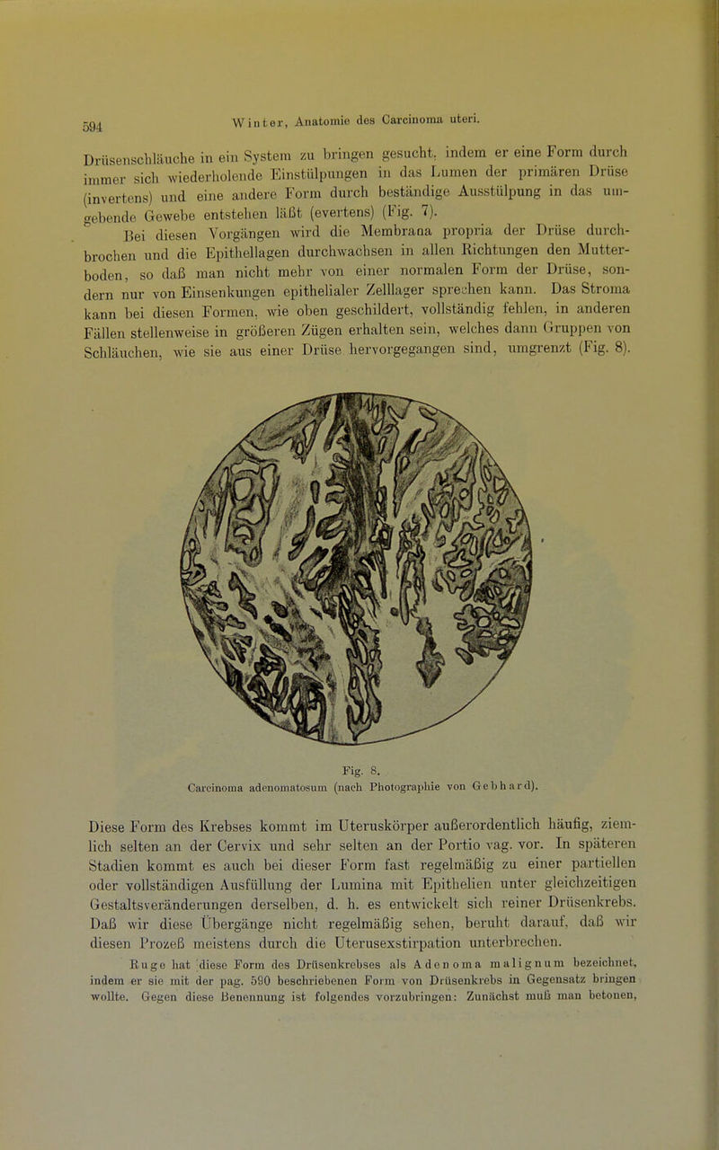 Drüsenschläuche in ein System zu bringen gesucht, indem er eine Form durch immer sich wiederholende Einstülpungen in das Lumen der primären Drüse (invertens) und eine andere Form durch beständige Ausstülpung in das um- gebende Gewebe entstehen läßt (evertens) (Fig. 7). Bei diesen Vorgängen wird die Membrana propria der Drüse durch- brochen und die Epithellagen durchwachsen in allen Richtungen den Mutter- boden, so daß man nicht mehr von einer normalen Form der Drüse, son- dern nur von Einsenkungen epithelialer Zelllager sprechen kann. Das Stroma kann bei diesen Formen, wie oben geschildert, vollständig fehlen, in anderen Fällen stellenweise in größeren Zügen erhalten sein, welches dann Gruppen von Schläuchen, wie sie aus einer Drüse hervorgegangen sind, umgrenzt (Fig. 8). Fig. 8. Carcinoma adenomatosum (nach Photographie von Gebhard). Diese Form des Krebses kommt im Uteruskörper außerordentlich häufig, ziem- lich selten an der Cervix und sehr selten an der Portio vag. vor. In späteren Stadien kommt es auch bei dieser Form fast regelmäßig zu einer partiellen oder vollständigen Ausfüllung der Lumina mit Epithelien unter gleichzeitigen Gestaltsveränderungen derselben, d. h. es entwickelt sich reiner Drüsenkrebs. Daß wir diese Übergänge nicht regelmäßig sehen, beruht darauf, daß wir diesen Prozeß meistens durch die Uterusexstirpation unterbrechen. Rüge hat ;diese Form des Drüsenkrebses als Adenoma malignum bezeichnet, indem er sie mit der pag. 590 beschriebenen Form von Drüsenkrebs in Gegensatz bringen wollte. Gegen diese Benennung ist folgendes vorzubringen: Zunächst muß man betonen.