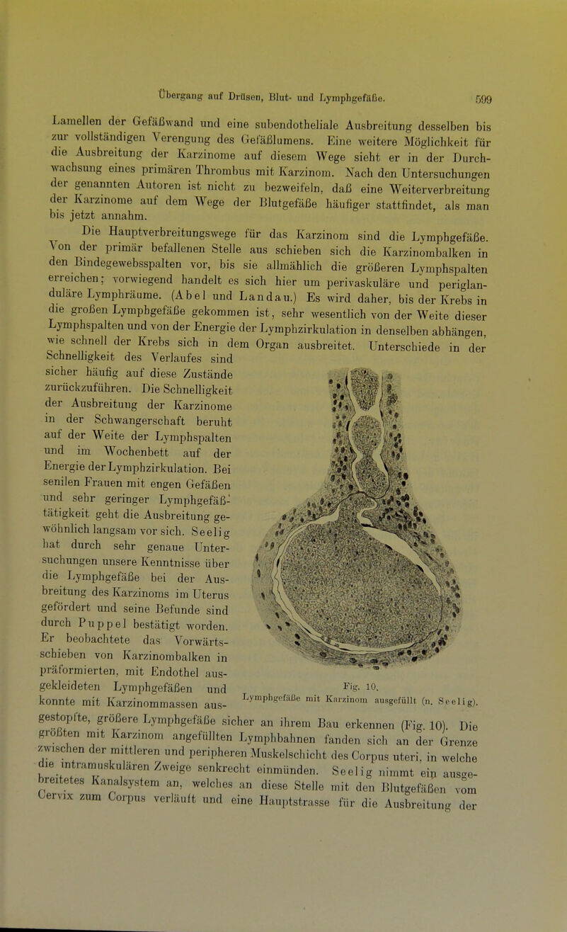 Übergang auf Drüsen, Blut- und Lymphgefäße. Lamellen der Gefäßwand und eine subendotheliale Ausbreitung desselben bis zur vollständigen Verengung des Getaßlumens. Eine weitere Möglichkeit für die Ausbreitung der Karzinome auf diesem Wege sieht er in der Durch- wachsung eines primären Thrombus mit Karzinom. Nach den Untersuchungen der genannten Autoren ist nicht zu bezweifeln, daß eine Weiterverbreitung der Karzinome auf dem Wege der Blutgefäße häufiger stattfindet, als man bis jetzt annahm. Die Hauptverbreitungswege für das Karzinom sind die Lymphgefäße. Von der primär befallenen Stelle aus schieben sich die Karzinombalken in den Bmdegewebsspalten vor, bis sie allmählich die größeren Lymphspalten erreichen; vorwiegend handelt es sich hier um perivaskuläre und periglan- duläre Lymphräume. (Abel und Landau.) Es wird daher, bis der Krebs in die großen Lymphgefäße gekommen ist, sehr wesentlich von der Weite dieser Lymphspalten und von der Energie der Lymphzirkulation in denselben abhängen wie schnell der Krebs sich in dem Organ ausbreitet. Unterschiede in der bchnelhgkeit des Verlaufes sind sicher häufig auf diese Zustände zurückzuführen. Die Schnelligkeit der Ausbreitung der Karzinome l P in der Schwangerschaft beruht auf der Weite der Lymphspalten • : M und im Wochenbett auf der 4 4^ Energie der Lymphzirkulation. Bei M^'L- \ senilen Frauen mit engen Gefäßen !f^? ■ ö'^^^l^ und sehr geringer Lymphgefäß- 'i -^^^?»v^ tätigkeit geht die Ausbreitung ge- wohnlich langsam vor sich. Seelig hat durch sehr genaue Unter- /f>/  ■ ' > suchungen unsere Kenntnisse über A , ' 0' die Lymphgefäße bei der Aus- * . breitung des Karzinoms im Uterus .V:\ gefördert und seine Befunde sind % n ^ durch Puppel bestätigt worden. > n Er beobachtete das Vorwärts- 5'' schieben von Karzinombalken in ' 7'<»'-,r * % *' * präformierten, mit Endothel aus- * gekleideten Lymphgefäßen und ^'S- ^0. konnte mit Karzinommassen aus- ^'^^^^'^'^^^^ Karzinom ausgefüllt (n. Seelig), gestopfte, größere Lymphgefäße sicher an ihrem Bau erkennen (Fig 10). Die größten mit Karzinom angefüllten Lymphbahnen fanden sich an der Grenze zwischen der mittleren und peripheren Muskelschicht des Corpus uteri, in welche die intramuskulären Zweige senkrecht einmünden. Seelig nimmt ein ausge- breitetes Kanalsystem an, welches an diese Stelle mit den Blutgefäßen vom t^ervix zum Corpus verläuft und eine Hauptstrasse für die Ausbreitung der