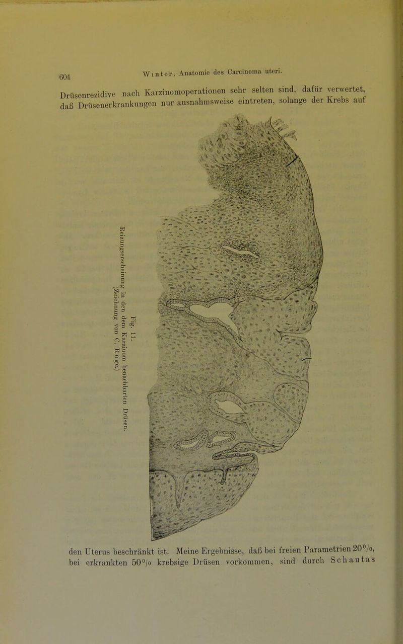 Drüsenrezidive nach Karzinomoperationen sehr selten sind, dafür verwertet, daß Drüsenerkrankungen nur ausnahmsweise eintreten, solange der Krebs auf > 3 5 c a 2. P o' er Pj a n> s ö 3 O 3 , .' > *» <» ^ -^l J 3 P rt> 3 I den Uterus beschränkt ist. Meine Ergebnisse, daß bei freien Parametrien 20%, bei erkrankten 50^/o krebsige Drüsen vorkommen, sind durch Schautas