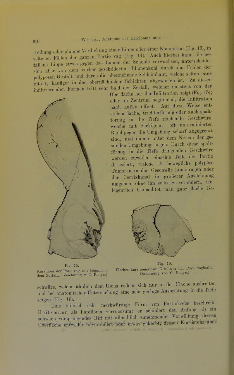 treibung oder plumpe Verdickung einer Lippe oder einer Kommissur (Fig 13) in eltenen Fällen der ganzen Portio vag. (Fig. 14) Auch hierbei kann dxe be- fallene Lippe etwas gegen das Lumen der Scheide vorwachsen unterscheidet sich aber von dem vorher geschilderten Blumenkohl durch das Fehlen der nolvpösen Gestalt und durch die überziehende Schleimhaut, welche selten ganz intakt häufiger in den oberflächlichen Schichten abgeworfen ist. Zu diesen infiltrierenden Formen tritt sehr bald der Zerfall, welcher meistens von der Oberfläche her der Infiltration folgt (iMg. lö); oder im Zentrum beginnend, die Lifiltration nach außen öffnet. Auf diese Weise ent- stehen flache, trichterförmig oder auch spalt- förmig in die Tiefe reichende Geschwüre, welche mit zackigem, oft unterminierten Rand gegen die Umgebung scharf abgegrenzt sind, und immer unter dem Niveau der ge- sunden Umgebung liegen. Durch diese spalt- förmig in die Tiefe dringenden Geschwüre werden zuweilen einzelne Teile der Portio - disseziert, welche als bewegliche polypöse Tumoren in das Geschwür hineinragen oder den Cervixkanal in größerer Ausdehnung umgeben, ohne ihn selbst zu verändern. Ge- legentlich beobachtet man ganz flache Ge- Fig. 15. Karzinom der Port. vag. mit beginnen- dem Zerfall. (Zeichnung v. C. Rüge.) Fig. 16. Flaches karzinomatöses GesehAVÜr der Port, vaginalis. (Zeichnung von C. Rüge.) schwüre, welche ähnlich dem Ulcus rodens sich nur in der Fläche ausbreiten und bei anatomischer Untersuchung eine sehr geringe Ausbreitung in die liete zeigen (Fig. 16). . i i i i -uf Eine klinisch sehr merkwürdige Form von Portiokrebs beschreibt Heitzmann als Papilloma verrucosum; er schildert den Anfang als ein schwach vorspringendes Riff mit allmählich zunehmender Vorwolbung, dessen Obtetfläche 'eiHHrea-et ühverätidert Mer etwas gekerbt,: dessen Konsistenz abei. {]y, ...^/.Itijy. y-iiov/X .ytllHH .!; l.niiH.III .^pjolo-Jütl.