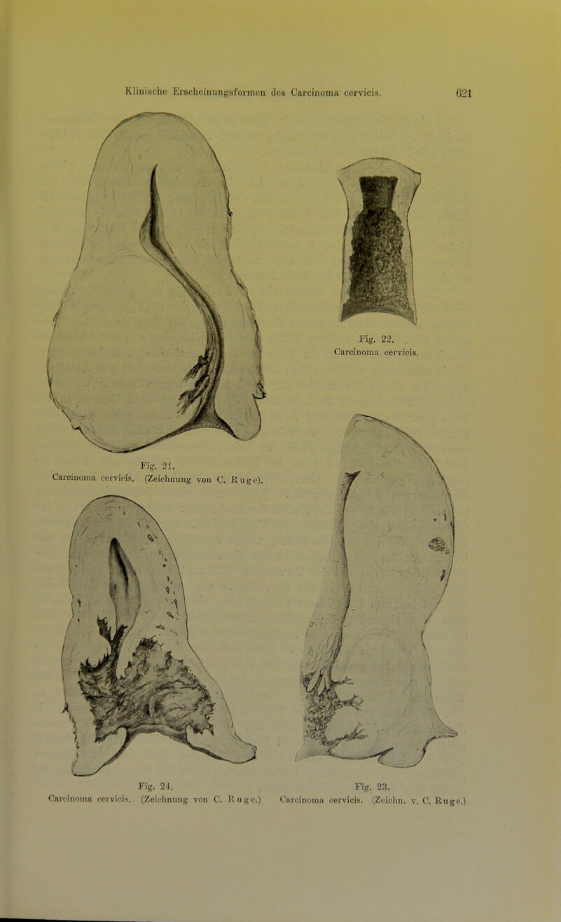 Fig. 24. Fig. 23. Carcinoma cervicis. (Zeichnung von C. liugc.) Carcinoma cervicis. (Zoichn. y. C. Euge.)