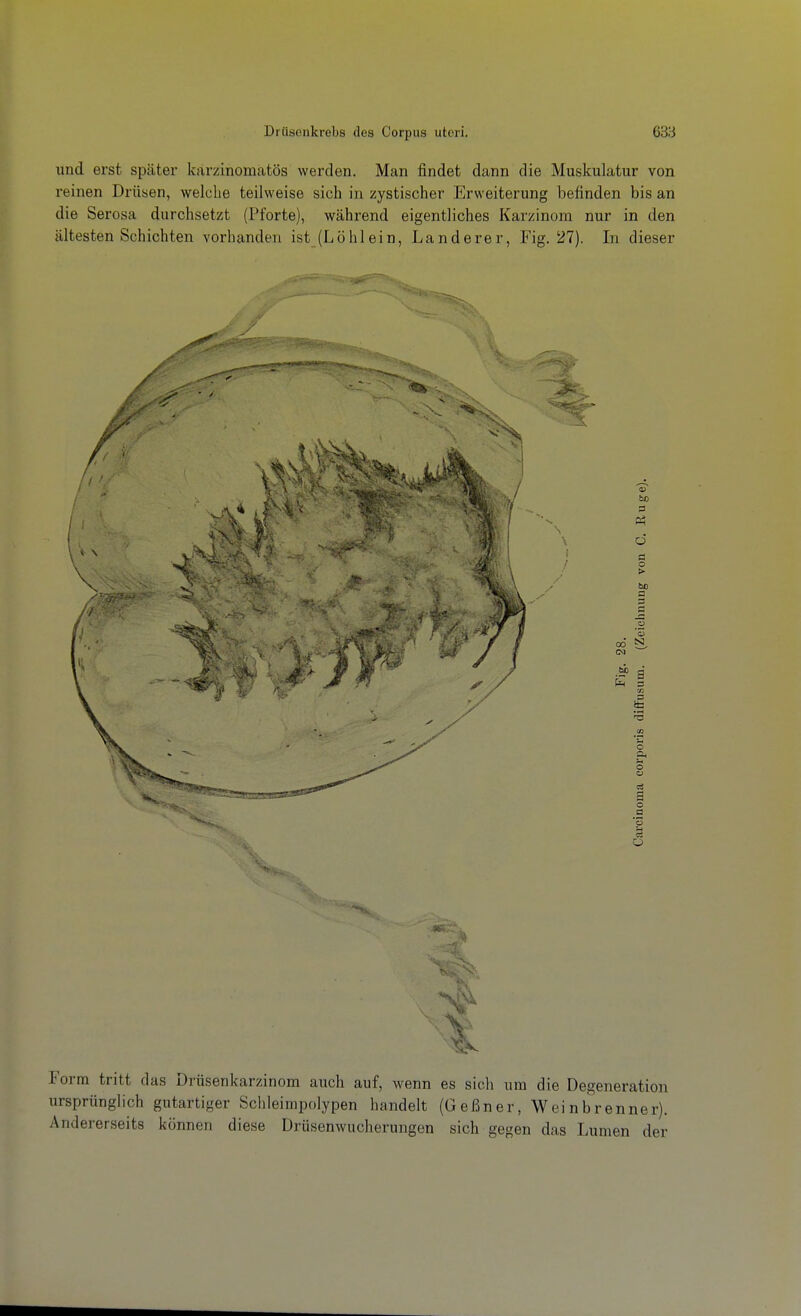 und erst später karzinomatös werden. Man findet dann die Muskulatur von reinen Drüsen, welche teilweise sich in zystischer Erweiterung befinden bis an die Serosa durchsetzt (Pforte), während eigentliches Karzinom nur in den ältesten Schichten vorhanden ist (Löhlein, Landerer, Fig. 27). In dieser Form tritt das Drüsenkarzinom auch auf, wenn es sich um die Degeneration ursprünglich gutartiger Schleimpolypen handelt (Geßner, Weinbrenner). Andererseits können diese Drüsenwucherungen sich gegen das Lumen der