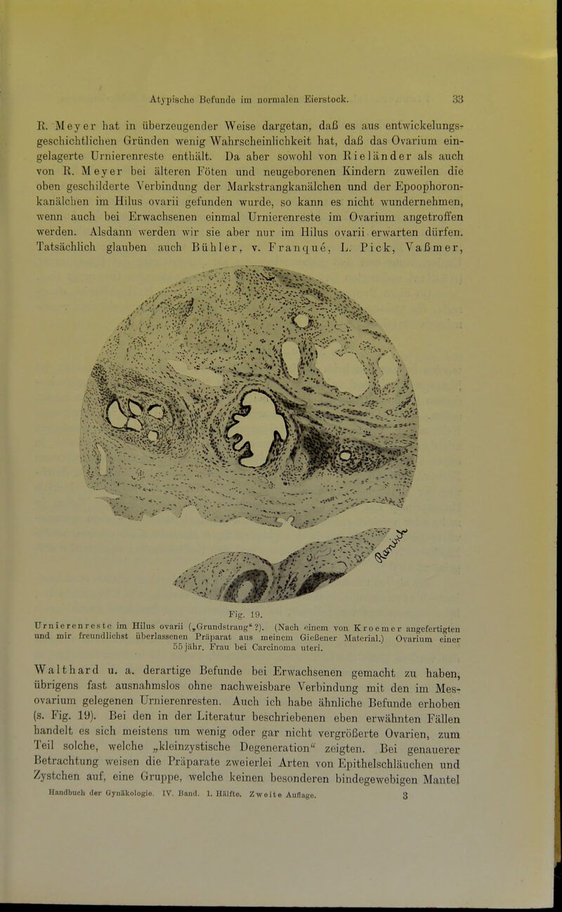 R. Meyer hat in überzeugender Weise dargetan, daß es ans entwickelungs- geschichtlichen Gründen wenig Wahrscheinlichkeit hat, daß das Ovarium ein- gelagerte ürnierenreste enthält. Da aber sowohl von Rielander als auch von R. Meyer bei älteren Föten und neugeborenen Kindern zuweilen die oben geschilderte Verbindung der Markstrangkanälchen und der Epoophoron- kanälchen im Hilus ovarii gefunden wurde, so kann es nicht wundernehmen, wenn auch bei Erwachsenen einmal Ürnierenreste im Ovarium angetroffen werden. Alsdann werden wir sie aber nur im Hilus ovarii erwarten dürfen. Tatsächlich glauben auch Bühler, v. Franque, L. Pick, Vaßmer, 1 * 'r, ' t.f; ■■■■■.:rr ' »>«:' Fig. 19. Ürnierenreste im Hilus ovarii („Grundstrang ?). (Nach einem von Kroemer angefertigten und mir freundlichst überlassenen Präparat aus meinem Gießener Material.) Ovarium einer 55 jähr. Frau bei Carcinoma uteri. Waithard u. a. derartige Befunde bei Erwachsenen gemacht zu haben, übrigens fast ausnahmslos ohne nachweisbare Verbindung mit den im Mes- ovarium gelegenen Urnierenresten. Auch ich habe ähnliche Befunde erhoben (s. Fig. 19). Bei den in der Literatur beschriebenen eben erwähnten Fällen handelt es sich meistens um wenig oder gar nicht vergrößerte Ovarien, zum Teil solche, welche ^.kleinzystische Degeneration'' zeigten. Bei genauerer Betrachtung weisen die Präparate zweierlei Arten von Epithelschläuchen und Zystchen auf, eine Gruppe, welche keinen besonderen bindegewebigen Mantel Handbuch der Gynäkologie. IV. Band. 1. HiUfto. Zweite Auflage. 3