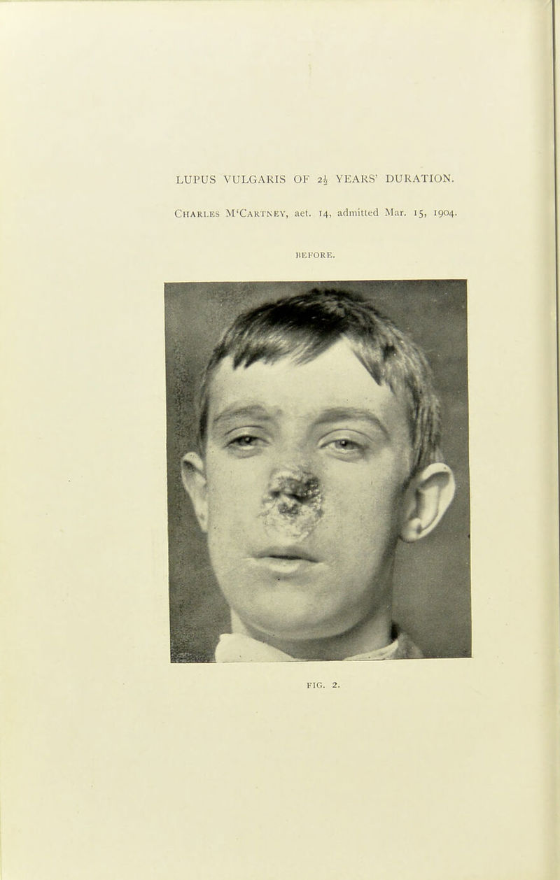 LUPUS VULGARIS OF 2i YEARS' DURATION. Charles M'Caktney, aet. 14, arlmiued Mar. 15, 1904. heI'ORE.