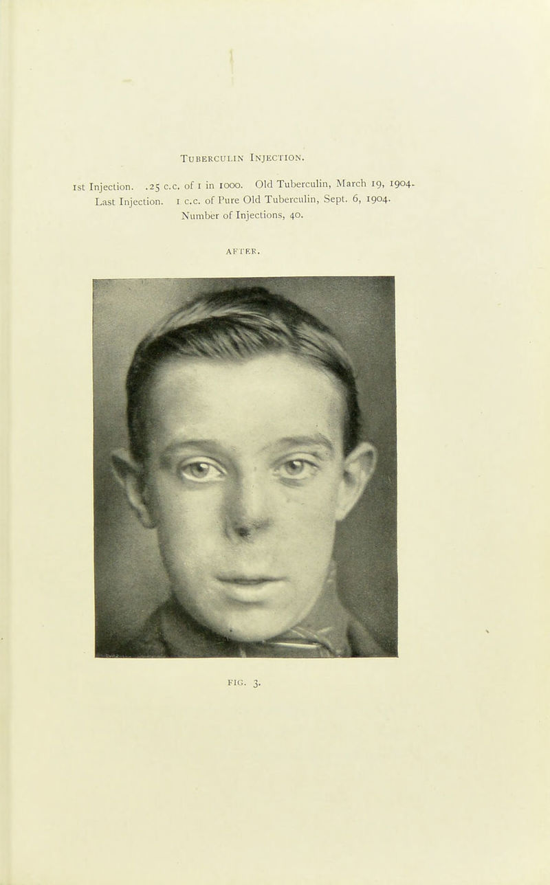 1 Tuberculin Injection. 1st Injection. .25 c.c. of i in 1000. Old Tuberculin, March 19, 1904. Last Injection, i c.c. of Pure Old Tuberculin, Sept. 6, 1904. Number of Injections, 40. AFrER.