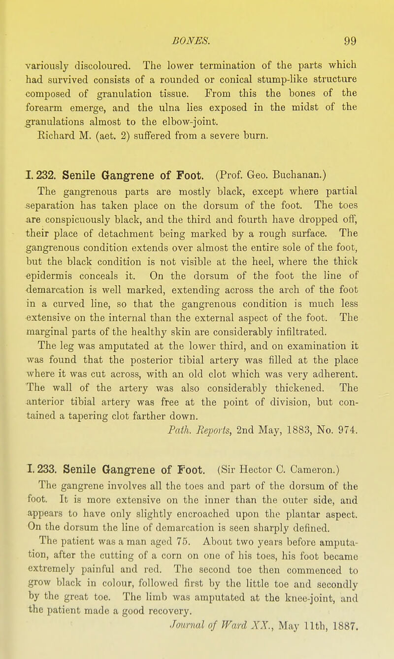 variously discoloured. The lower termination of the parts which had survived consists of a rounded or conical stump-like structure composed of granulation tissue. From this the bones of the forearm emerge, and the ulna lies exposed in the midst of the granulations almost to the elbow-joint. Richard M. (aet. 2) suflfered from a severe burn. 1.232. Senile Gangrene of Foot. (Prof. Geo. Buchanan.) The gangrenous parts are mostly black, except where partial separation has taken place on the dorsum of the foot. The toes are conspicuously black, and the third and fourth have dropped off, their place of detachment being marked by a rough surface. The gangrenous condition extends over almost the entire sole of the foot, but the black condition is not visible at the heel, where the thick epidermis conceals it. On the dorsum of the foot the line of demarcation is well marked, extending across the arch of the foot in a curved line, so that the gangrenous condition is much less extensive on the internal than the external aspect of the foot. The marginal parts of the healthy skin are considerably infiltrated. The leg was amputated at the lower third, and on examination it was found that the posterior tibial artery was filled at the place where it was cut across, with an old clot which was very adherent. The wall of the artery was also considerably thickened. The anterior tibial artery was free at the point of division, but con- tained a tapering clot farther down. Path. Reports, 2nd May, 1883, No. 974. 1.233. Senile Gangrene of Foot. (Sir Hector C. Cameron.) The gangrene involves all the toes and part of the dorsum of the foot. It is more extensive on the inner than the outer side, and appears to have only slightly encroached upon the plantar aspect. On the dorsum the line of demarcation is seen sharply defined. The patient was a man aged 75. About two years before amputa- tion, after the cutting of a corn on one of his toes, his foot became extremely painful and red. The second toe then commenced to grow black in colour, followed first by the little toe and secondly by the great toe. The limb was amputated at the knee-joint, and the patient made a good recovery. Journal of Ward XX., May 11 th, 1887.