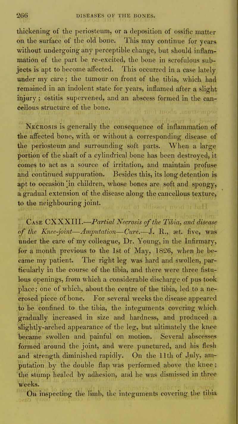 thickening of the periosteum, or a deposition of ossific matter on the surface of the old bone. This may continue for years without undergoing any perceptible change, but should inflam- mation of the part be re-excited, the bone in scrofulous sub- jects is apt to become affected. This occurred in a case lately under my care; the tumour on front of the tibia, which had remained in an indolent state for years, inflamed after a slight injury; ostitis supervened, and an abscess formed in the can- cellous structure of the bone. Necrosis is generally the consequence of inflammation of the affected bone, with or without a corresponding disease of the periosteum and surrounding soft parts. When a large portion of the shaft of a cylindrical bone has been destroyed, it comes to act as a source of irritation, and maintain profuse and continued suppuration. Besides this, its long detention is apt to occasion [in children, whose bones are soft and spongy, a gradual extension of the disease along the cancellous texture, to the neighbouring joint. Case CXXXIII.'—Partial Necrosis of the Tibia, and disease of the Knee-joint—Amputation—Cure.—J. E,., set. five, was under the care of my colleague. Dr. Young, in the Infirmary, for a month previous to the 1st of May, 1826, when he be- came my patient. The right leg was hard and swollen, par- ticularly in the course of the tibia, and there were three fistu- lous openings, from which a considerable discharge of pus took place; one of which, about the centre of the tibia, led to a ne- crosed piece of bone. For several weeks the disease appeared to be confined to the tibia, the integuments covering which gradually increased in size and hardness, and produced a slightly-arched appearance of the leg, but ultimately the knee became swollen and painful on motion. Several abscesses formed around the joint, and were punctured, and his flesh and strength diminished rapidly. On the 11th of July, am- putation by the double flap was performed above the knee; the stump healed by adhesion, and he was dismissed in three Veeks. Oh inspecting the limb, the integuments covering the tibia