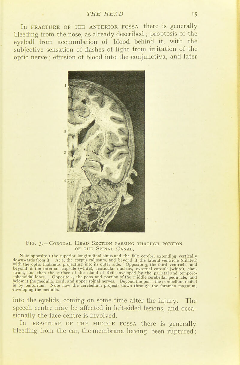 In FRACTURE OF THE ANTERIOR FOSSA there is generally bleeding from the nose, as already described ; proptosis of the e5^eball from accumulation of blood behind it, with the subjective sensation of flashes of light from irritation of the optic nerve ; effusion of blood into the conjunctiva, and later Fig. 3.—Coronal Head Section passing through portion OF THE Spinal Canal. Note opposite i the superior longitudinal sinus and the falx cerebri extending vertically downwards from it. At 2, the corpus callosum, and beyond it the lateral ventricle (dilated) with the optic thalamus projecting into its outer side. Opposite 3, the third ventricle, and beyond it the internal capsule (white), lenticular nucleus, external capsule (white), clau- strum, and then the surface of the island of Reil enveloped by the parietal and temporo- sphenoidal lobes. Opposite 4, thepons and portion of the middle cerebellar peduncle, and below it the medulla, cord, and upper spinal nerves. Beyond the pons, the cerebellum roofed in by tentorium. Note how the cerebellum projects down through the foramen magnum, enveloping the medulla. into the eyelids, coming on some time after the injury. The speech centre may be affected in left-sided lesions, and occa- sionally the face centre is involved. In FRACTURE OF THE MIDDLE FOSSA there is generally bleeding from the ear, the membrana having been ruptured;