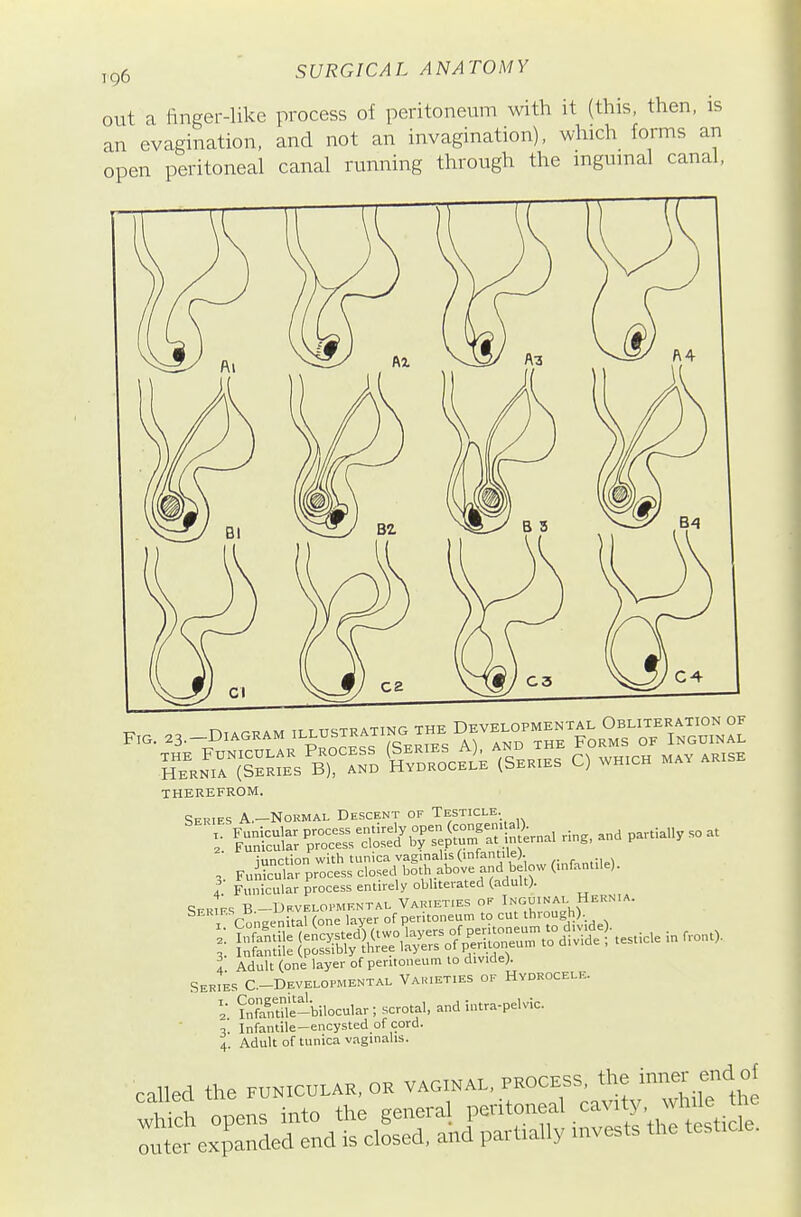 j,g6 ' SURGICAL ANATOMY out a finger-like process of peritoneum with it (this, then, is an evagination, and not an invagination), which forms an open peritoneal canal running through the ingumal canal. THEREFROM. Series A.—Normal Descent of Testicle. '¥st^S3qiSf:^^...p.«i*>- 4 Adult (one layer of peritoneum to divide). Series C.-Developmental Vakieties of Hydrocele. SS-bilocular; scrotal, and intra-pelvic. Infantile-encysted of cord. 4. Adult of tunica vaginalis. called the funicular, or vaginal, process, the ^^^^^ j;;^^ ^^ wS opens into the general l-toneal cavity, wh^^^^^^^^^ Tuter expanded end is closed, and partially invests the testicle.