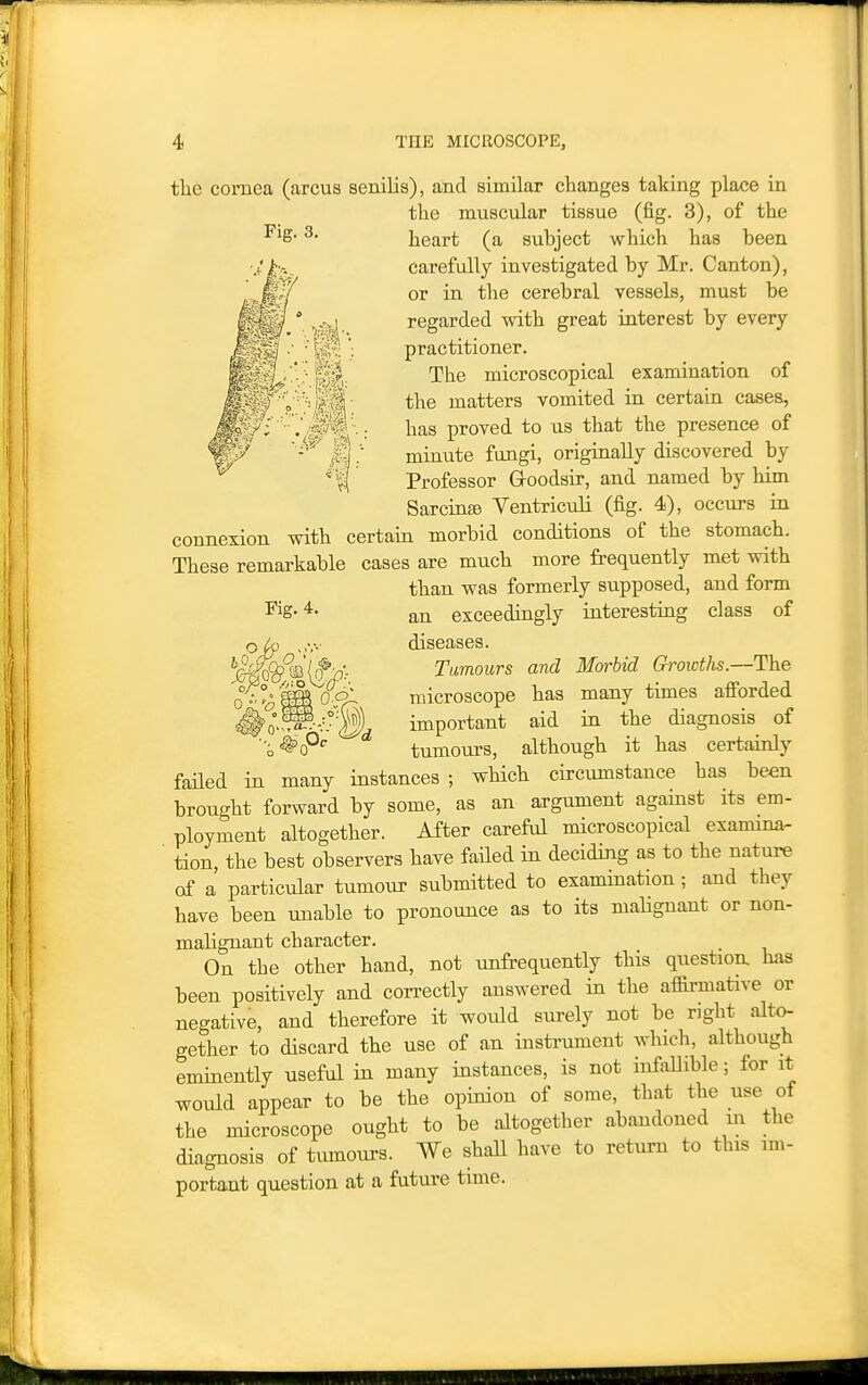 tlie cornea (arcus senilis), and similar changes taking place in the muscular tissue (fig. 3), of the ■^^S- 3. heart (a subject which has been carefully investigated by Mr. Canton), or in the cerebral vessels, must be regarded with great iaterest by every practitioner. The microscopical examination of the matters vomited in certain cases, has proved to us that the presence of minute fungi, originally discovered by Professor Groodsir, and named by him Sarcinaj Ventriculi (fig. 4), occurs in connexion with certam morbid conditions of the stomach. These remarkable cases are much more frequently met with than was formerly supposed, and form ^^S-*- an exceedmgly interesting class of o ,,v.- diseases. ^e^f®'&- Tumours and Morbid Groioths.--Th.e 0 - °^ ® O ff- microscope has many times afi'orded important aid in the diagnosis of • ^^0°'' tumours, although it has certainly faHed in many instances ; which circumstance has been brought forward by some, as an argument against its em- ployment altogether. After careful microscopical examina- tion, the best observers have failed in deciding as to the nature of a particular tumour submitted to examination; and they have been unable to pronounce as to its mahgnant or non- malignant character. On the other hand, not unfrequently this question has been positively and correctly answered in the afl5rmative or negative, and therefore it would surely not be right alto- gether to discard the use of an instrument which, although eminently useful in many instances, is not infallible; for it would appear to be the opinion of some, that the use of the microscope ought to be altogether abandoned in the diagnosis of tumours. We shall have to return to this im- portant question at a future time.