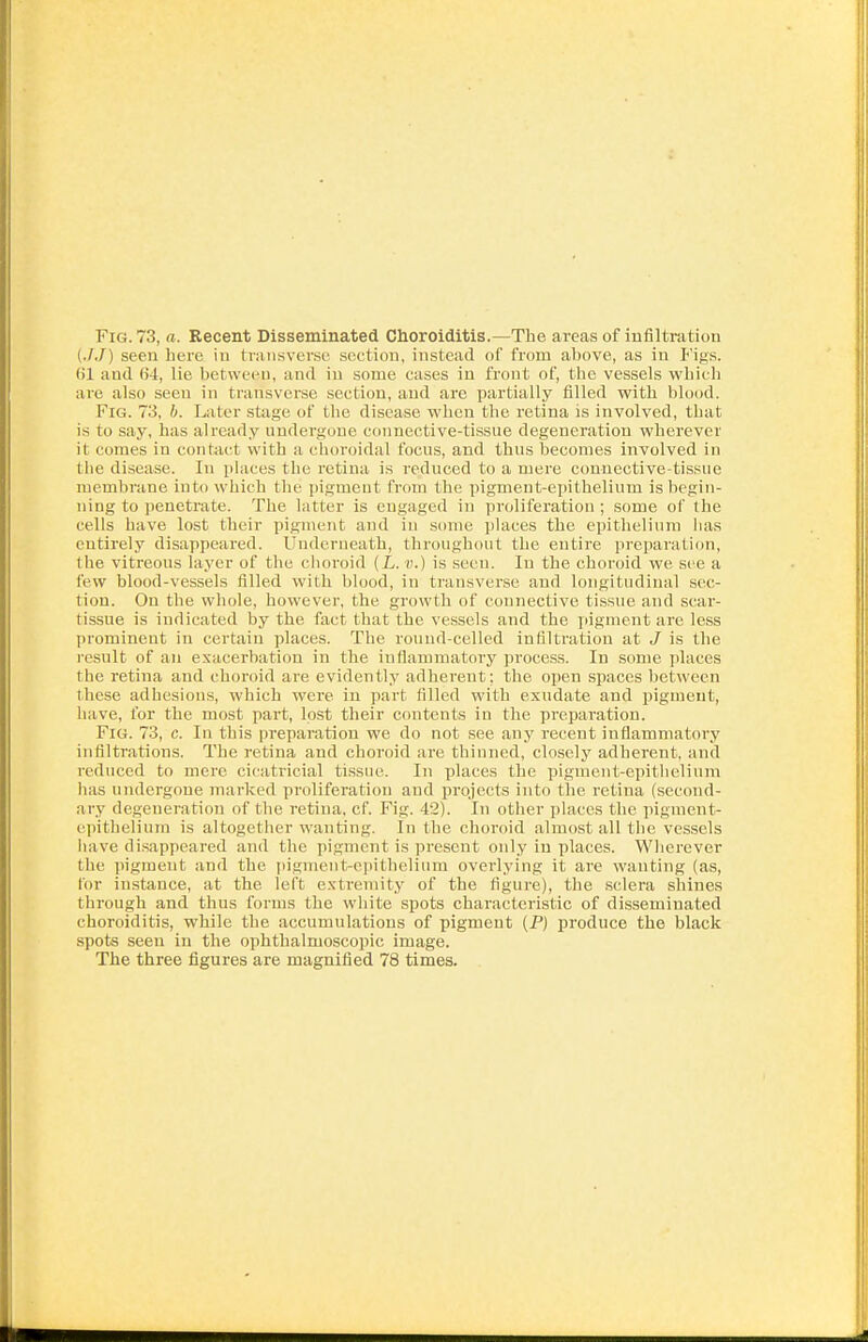Fig. 78, a. Recent Disseminated Choroiditis.—The areas of infiltration (JJ) seen here in transverse section, instead of from above, as in Figs, (il and 64, lie between, and in some cases in front of, the vessels which are also seen in transverse section, and are partially filled with blood. Fig. 73, h. Later stage of the disease when the retina is involved, that is to say, has already undergone connective-tissue degeneration wherever it comes in contact with a choroidal focus, and thus becomes involved in the disease. In places the retina is reduced to a mere connective-tissue membrane into which the pigment from the pigment-epithelium is begin- ning to penetrate. The latter is engaged in proliferation ; some of the cells have lost their pigment and in some places the epithelium has entirely disappeared. Underneath, throughout the entire preparation, the vitreous layer of the choroid (L. v.) is seen. In the choroid we see a lew blood-vessels filled with blood, in transverse and longitudinal sec- tion. On the whole, however, the growth of connective tissue and scar- tissue is indicated by the fact that the vessels and the pigment are less prominent in certain places. The round-celled infiltration at J is the result of an exacerbation in the inflammatory process. In some places the retina and choroid are evidently adherent: the open spaces between these adhesions, which were, in part filled with exudate and pigment, hiive, for the most part, lost their contents in the preparation. Fig. 73, c. In this preparation we do not see any recent inflammatory infiltrations. The retina and choroid are thinned, closely adherent, and reduced to mere cicatricial tissue. In places the pigment-epithelium has undergone marked proliferation and projects into the retina (second- ary degeneration of the retina, cf. Fig. 42). In other places the pigment- epithelium is altogether wanting. In the choroid almost all the vessels have disappeared and the pigment is present only in places. Wherever the pigment and the pigment-epithelium overlying it are wanting (as, for instance, at the left extremity of the figure), the sclera shines through and thus forms the wThite spots characteristic of disseminated choroiditis, while the accumulations of pigment (P) produce the black spots seen in the ophthalmoscopic image. The three figures are magnified 78 times.