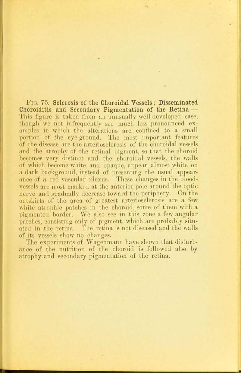 Choroiditis and Secondary Pigmentation of the Retina.— This figure is taken from an unusually well-developed case, though we not infrequently see much less pronounced ex- amples in which the alterations are confined to a small portion of the eye-ground. The most important features of the disease are the arteriosclerosis of the choroidal vessels and the atrophy of the retinal pigment, so that the choroid becomes very distinct and the choroidal vessels, the walls of which become white and opaque, appear almost white on a dark background, instead of presenting the usual appear- ance of a red vascular plexus. These changes in the blood- vessels are most marked at the anterior pole around the optic nerve and gradually decrease toward the periphery. On the outskirts of the area of greatest arteriosclerosis are a few white atrophic patches in the choroid, some of them with a pigmented border. We also see in this zone a few angular patches, consisting only of pigment, which are probably situ- ated in the retina. The retina is not diseased and the walls of its vessels show no changes. The experiments of Wagenmann have shown that disturb- ance of the nutrition of the choroid is followed also by atrophy and secondary pigmentation of the retina.