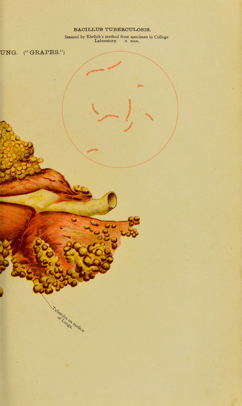 BAOILLUS TtrBBROUIiOSIS. Stained by Ehrlich's method from specimen in College Laboratory. x 2000.