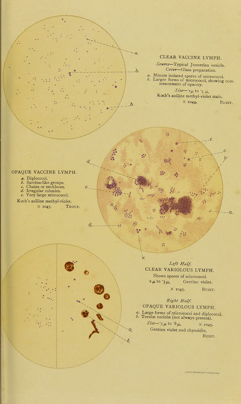 CLEAR VACCINE LYMPH. Source—Typical Jennerian vesicle. CoveK—Glass preparation. a. Minute isolated spores of micrococci. 6. Larger forms of micrococci, showing com- mencement of opacity. Size—-Xfi to -5 /X. Koch's aniline methyl-violet stain. X 104s. BuiST. OPAQUE VACCINE LYMPH. a, Diplococci. 6. Sarcina-like groups. c. Chains or necklaces. d. Irregular colonies. e. Very large micrococci. Koch's aniline methyl-violet. X 1045. Troup. 5 • -a. Left Half. CLEAR VARIOLOUS LYMPH. Shows spores of micrococci. ■a/xto*3yr(. Gentian violet. X 1045. BuiST. Right Half. OPAQUE VARIOLOUS LYMPH. fof^s of micrococci and diplococci. 0. lorulae variola (not always present). Size—-sfi.\.o -S/x. X 1045. ct Gentian violet and chysoidin. BuiST.