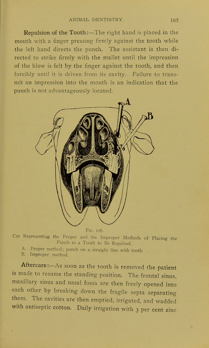 Repulsion of the Tooth:—The right hand is placed in the mouth with a finger pressing firmly against the tooth while the left hand directs the punch. The assistant is then di- rected to strike firmly with the mallet until the impression of the blow is felt by the finger against the tooth, and then forcibly until it is driven from its cavity. Failure to trans- mit an impression into the mouth is an indication that the punch is not advantageously located. Fig. ii6. Cut Representing the Proper and the Improper Methods of Placing the Punch to a Tooth to Be Repulsed. A. Proper method; punch on a straight line with tooth. B. Improper method. Aftercare:—As soon as the tooth is removed the patient is made to resume the standing position. The frontal sinus, maxillary sinus and nasal fossa are then freely opened into each other by breaking down the fragile septa separating them. The cavities are then emptied, irrigated, and wadded with antiseptic cotton. Daily irrigation with 3 per cent zinc
