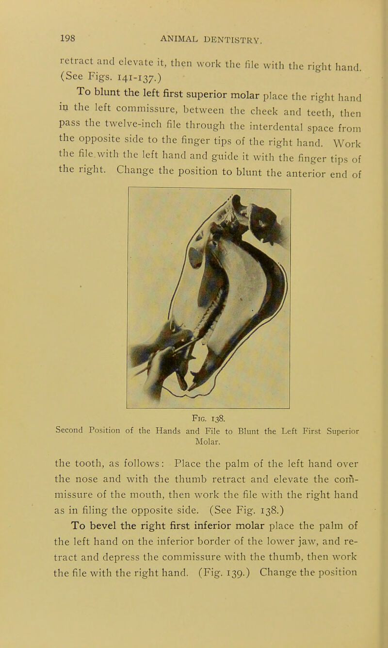 retract and elevate it, then work the file with the right hand. (See Figs. 141-137.) To blunt the left first superior molar place the right hand in the left commissure, between the cheek and teeth, then pass the twelve-inch file through the interdental space' from the opposite side to the finger tips of the right hand. Work the file with the left hand and guide it with the finger tips of the right. Change the position to blunt the anterior end of Fig. 138. Second Position of tlie Hands and File to Blunt the Left First Superior Molar. the tooth, as follows: Place the palm of the left hand over the nose and with the thumb retract and elevate the com- missure of the mouth, then work the file with the right hand as in filing the opposite side. (See Fig. 138.) To bevel the right first inferior molar place the palm of the left hand on the inferior border of the lower jaw, and re- tract and depress the commissure with the thumb, then work the file with the right hand. (Fig. 139.) Change the position