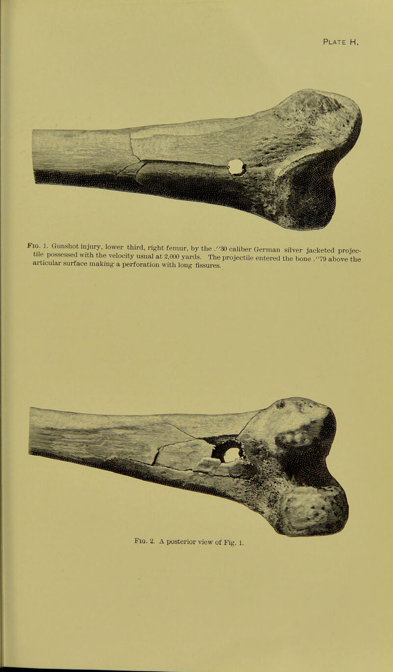 Fig 1. Gunshot injury, lower third, right femur, by the .30 caliber German silver jacketed projec- tile possessed with the velocity usual at 3,000 yards. The projectile entered the bone .79 above the ai-ticular surface making a perforation with long flssui-es.