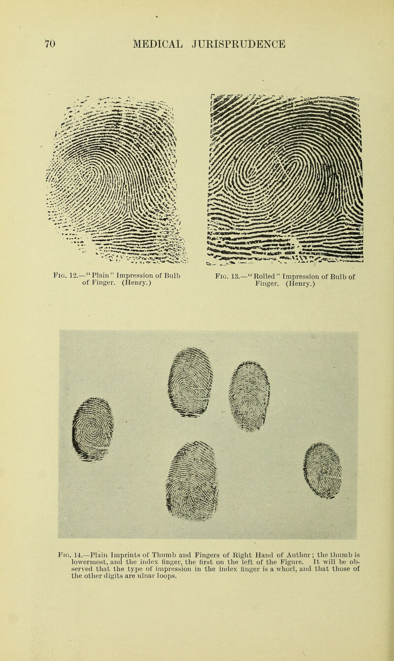 Fig. 12.— Plain  Impression of Bulb Fig. 13.— Rolled  Impression of Bulb of of Finger. (Henry.) Finger. (Henry.) Fio. 14.—Plain- Imprints of Thumb and Fingers of Right Hand of Author; the thumb is lowermost, and the index finger, the first on the left of the Figure. It will be ob- served that the type of impression in the index finger is a whorl, and that those of the other digits are ulnar loops.