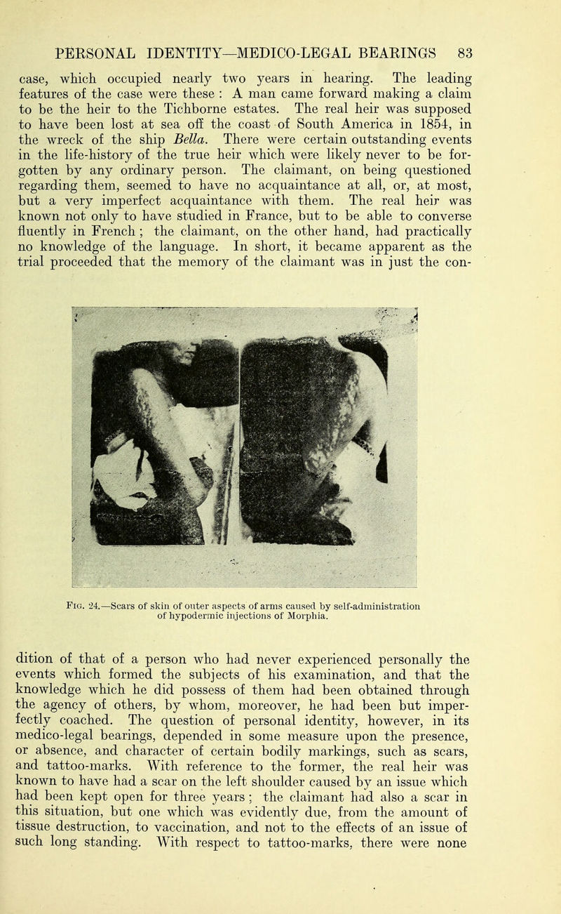 case, which occupied nearly two years in hearing. The leading features of the case were these : A man came forward making a claim to be the heir to the Tichborne estates. The real heir was supposed to have been lost at sea off the coast of South America in 1854, in the wreck of the ship Bella. There were certain outstanding events in the life-history of the true heir which were likely never to be for- gotten by any ordinary person. The claimant, on being questioned regarding them, seemed to have no acquaintance at all, or, at most, but a very imperfect acquaintance with them. The real heir was known not only to have studied in France, but to be able to converse fluently in French ; the claimant, on the other hand, had practically no knowledge of the language. In short, it became apparent as the trial proceeded that the memory of the claimant was in just the con- dition of that of a person who had never experienced personally the events which formed the subjects of his examination, and that the knowledge which he did possess of them had been obtained through the agency of others, by whom, moreover, he had been but imper- fectly coached. The question of personal identity, however, in its medico-legal bearings, depended in some measure upon the presence, or absence, and character of certain bodily markings, such as scars, and tattoo-marks. With reference to the former, the real heir was known to have had a scar on the left shoulder caused by an issue which had been kept open for three years ; the claimant had also a scar in this situation, but one which was evidently due, from the amount of tissue destruction, to vaccination, and not to the effects of an issue of such long standing. With respect to tattoo-marks, there were none