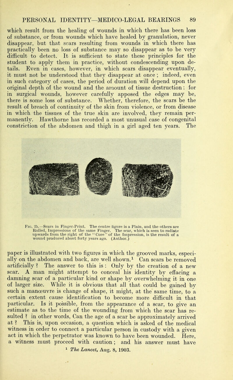 which result from the healing of wounds in which there has been loss of substance, or from wounds which have healed by granulation, never disappear, but that scars resulting from wounds in which there has practically been no loss of substance may so disappear as to be very difficult to detect. It is sufficient to state these principles for the student to apply them in practice, without condescending upon de- tails. Even in cases, however, in which scars disappear eventually, it must not be understood that they disappear at once; indeed, even in such category of cases, the period of duration will depend upon the original depth of the wound and the amount of tissue destruction: for in surgical wounds, however carefully apposed the edges may be, there is some loss of substance. Whether, therefore, the scars be the result of breach of continuity of the skin from violence, or from disease in which the tissues of the true skin are involved, they remain per- manently. Hawthorne has recorded a most unusual case of congenital constriction of the abdomen and thigh in a girl aged ten years. The Fig. 25.—Scars in Finger-Print. The centre figure is a Plain, and the others are Rolled, Impressions of the same Finger. The scar, which is seen to radiate upwards from the right of the  Core of the Impression, is the result of a wound produced about forty years ago. (Author.) paper is illustrated with two figures in which the grooved marks, especi- ally on the abdomen and back, are well shown.^ Can scars be removed artificially ? The answer to this is : Only by the creation of a new scar. A man might attempt to conceal his identity by effacing a damning scar of a particular kind or shape by overwhelming it in one of larger size. While it is obvious that all that could be gained by such a manoeuvre is change of shape, it might, at the same time, to a certain extent cause identification to become more difficult in that particular. Is it possible, from the appearance of a scar, to give an estimate as to the time of the wounding from which the scar has re- sulted ? in other words, Can the age of a scar be approximately arrived at ? This is, upon occasion, a question which is asked of the medical witness in order to connect a particular person in custody with a given act in which the perpetrator was known to have been wounded. Here, a witness must proceed with caution; and his answer must have 1 The Lancet, Aug. 8, 1903.