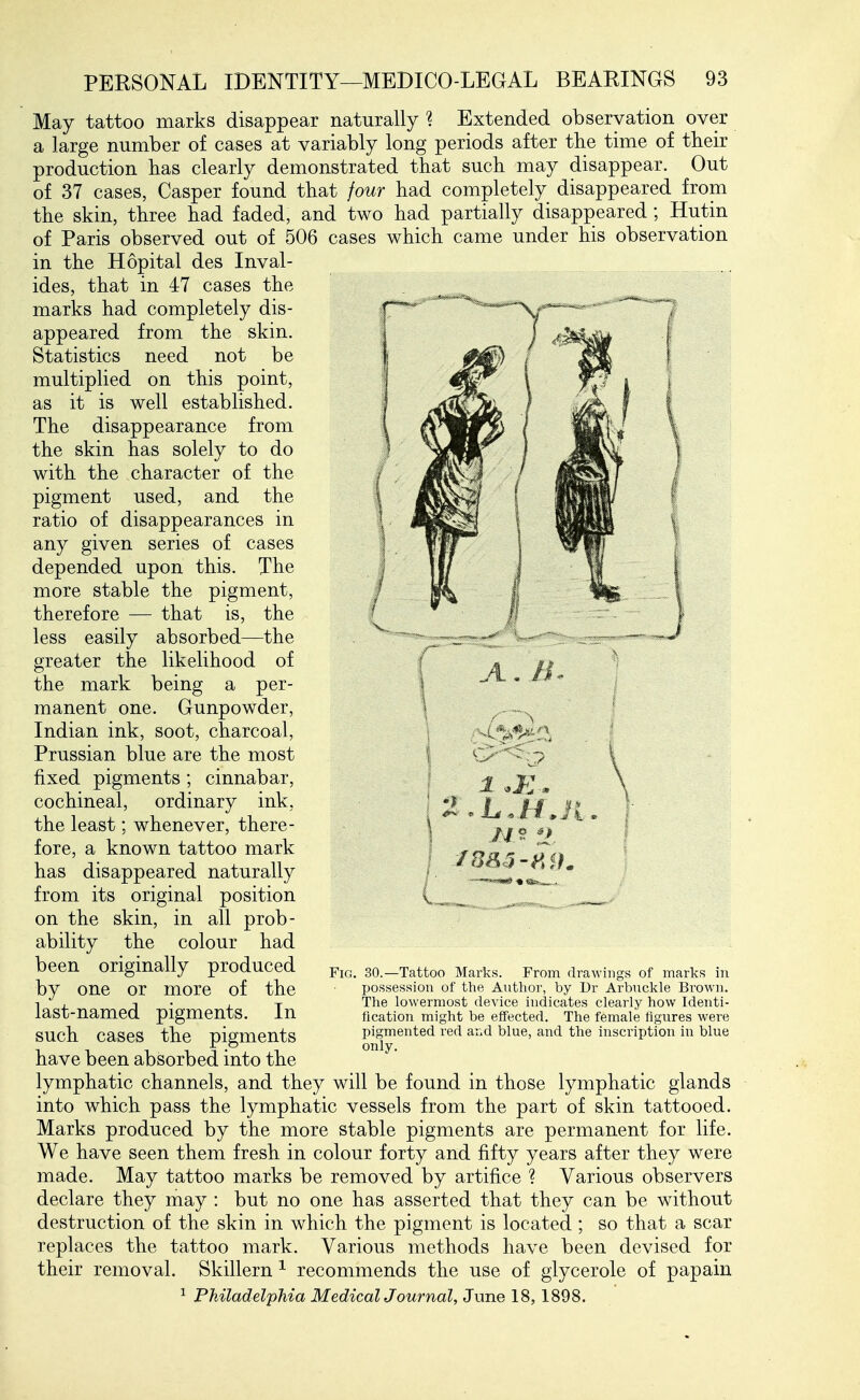 May tattoo marks disappear naturally ? Extended observation over a large number of cases at variably long periods after the time of their production has clearly demonstrated that such may disappear. Out of 37 cases, Casper found that four had completely disappeared from the skin, three had faded, and two had partially disappeared; Hutin of Paris observed out of 506 cases which came under his observation in the Hopital des Inval- ides, that in 47 cases the marks had completely dis- appeared from the skin. Statistics need not be multiplied on this point, as it is well established. The disappearance from the skin has solely to do with the character of the pigment used, and the ratio of disappearances in any given series of cases depended upon this. The more stable the pigment, therefore — that is, the less easily absorbed—the greater the likelihood of the mark being a per- manent one. Gunpowder, Indian ink, soot, charcoal, Prussian blue are the most fixed pigments; cinnabar, cochineal, ordinary ink, the least: whenever, there- fore, a known tattoo mark has disappeared naturally from its original position on the skin, in all prob- ability the colour had been originally produced by one or more of the last-named pigments. In such cases the pigments have been absorbed into the lymphatic channels, and they will be found in those lymphatic glands into which pass the lymphatic vessels from the part of skin tattooed. Marks produced by the more stable pigments are permanent for life. We have seen them fresh in colour forty and fifty years after they were made. May tattoo marks be removed by artifice ? Various observers declare they may : but no one has asserted that they can be without destruction of the skin in which the pigment is located ; so that a scar replaces the tattoo mark. Various methods have been devised for their removal. Skillern ^ recommends the use of glycerole of papain ^ Philadelphia MedicalJournal, June 18, 1898. .4, /i. Fig. 30, Tattoo Marks. From drawings of marks in possession of the Author, by Dr Arbnckle Brown. The lowermost device indicates clearly how Identi- fication might be effected. The female figures were pigmented red ar.d blue, and the inscription in blue only.