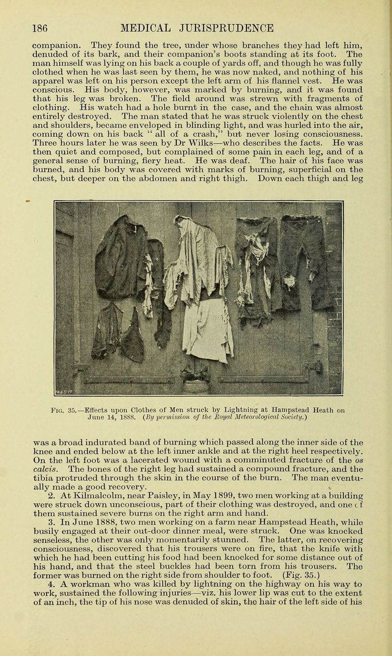 companion. They found the tree, under whose branches they had left him, denuded of its bark, and their companion's boots standing at its foot. The man himself was lying on his back a couple of yards off, and though he was fully clothed when he was last seen by them, he was now naked, and nothing of his apparel was left on his person except the left arm of his flannel vest. He was conscious. His body, however, was marked by burning, and it was found that his leg was broken. The field around was strewn with fragments of clothing. His watch had a hole burnt in the case, and the chain was almost entirely destroyed. The man stated that he was struck violently on the chest and shoulders, became enveloped in blinding light, and was hurled into the air, coming down on his back  all of a crash, but never losing consciousness. Three hours later he was seen by Dr Wilks—who describes the facts. He was then quiet and composed, but complained of some pain in each leg, and of a general sense of burning, fiery heat. He was deaf. The hair of his face was burned, and his body was covered with marks of burning, superficial on the chest, but deeper on the abdomen and right thigh. Down each thigh and leg Fig. 35.—Effects upon Clothes of Men struck by Lightning at Hanipstead Heath on June 14, 1888. {By permission of the Royal Meteorological Society.) was a broad indurated band of burning which passed along the inner side of the knee and ended below at the left inner ankle and at the right heel respectively. On the left foot was a lacerated wound with a comminuted fracture of the os calcis. The bones of the right leg had sustained a compound fracture, and the tibia protruded through the skin in the course of the burn. The man eventu- ally made a good recovery. 2. At Kilmalcolm, near Paisley, in May 1899, two men working at a building were struck down unconscious, part of their clothing was destroyed, and one c f them sustained severe burns on the right arm and hand. 3. In June 1888, two men working on a farm near Hampstead Heath, while busily engaged at their out-door dinner meal, were struck. One was knocked senseless, the other was only momentarily stunned. The latter, on recovering consciousness, discovered that his trousers were on fire, that the knife with which he had been cutting his food had been knocked for some distance out of his hand, and that the steel buckles had been torn from his trousers. The former was burned on the right side from shoulder to foot. (Fig. 35.) 4. A workman who was killed by lightning on the highway on his way to work, sustained the following injuries—viz. his lower lip was cut to the extent of an inch, the tip of his nose was denuded of skin, the hair of the left side of his