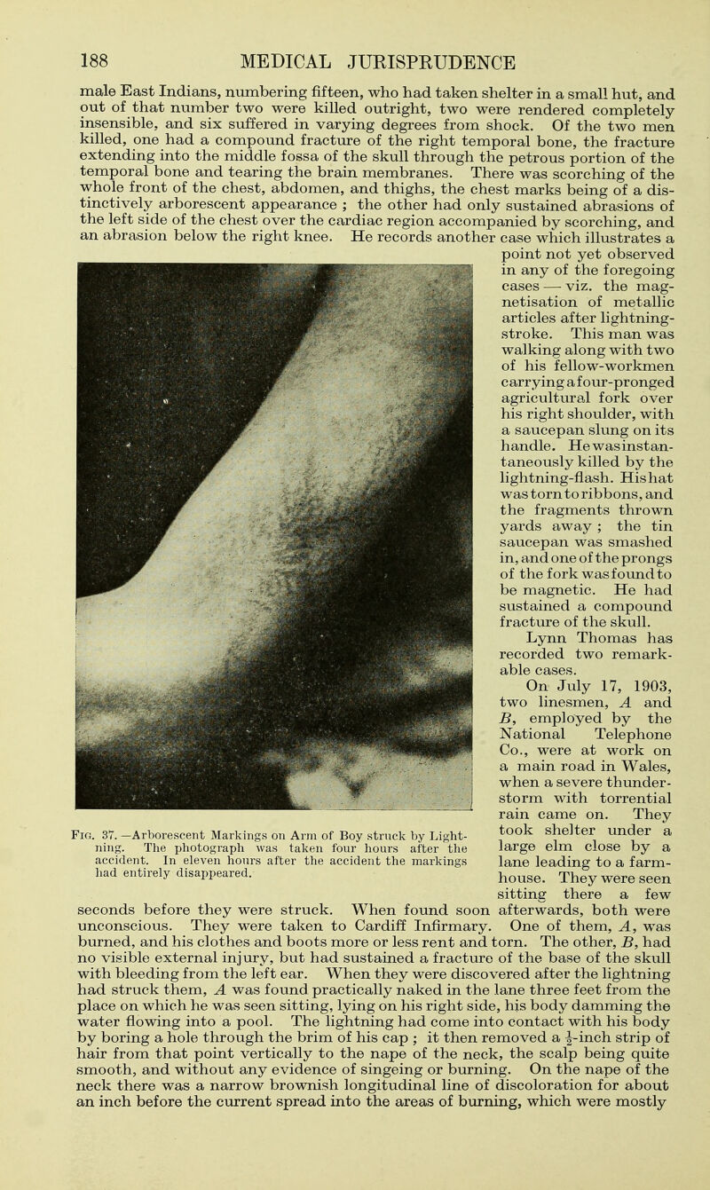 male East Indians, numbering fifteen, who had taken shelter in a small hut, and out of that number two were killed outright, two were rendered completely- insensible, and six suffered in varying degrees from shock. Of the two men killed, one had a compound fracture of the right temporal bone, the fracture extending into the middle fossa of the skull through the petrous portion of the temporal bone and tearing the brain membranes. There was scorching of the whole front of the chest, abdomen, and thighs, the chest marks being of a dis- tinctively arborescent appearance ; the other had only sustained abrasions of the left side of the chest over the cardiac region accompanied by scorching, and an abrasion below the right knee. He records another case which illustrates a point not yet observed in any of the foregoing cases — viz. the mag- netisation of metallic articles after lightning- stroke. This man was walking along with two of his fellow-workmen carrying a four-pronged agricultural fork over his right shoulder, with a saucepan slung on its handle. He was instan- taneously killed by the lightning-flash. His hat was torn to ribbons, and the fragments thrown yards away ; the tin saucepan was smashed in, and one of the prongs of the fork was found to be magnetic. He had sustained a compound fracture of the skull. Lynn Thomas has recorded two remark- able cases. On July 17, 1903, two linesmen, A and B, employed by the National Telephone Co., were at work on a main road in Wales, when a severe thunder- storm with torrential rain came on. They took shelter under a large elm close by a lane leading to a farm- house. They were seen sitting there a few seconds before they were struck. When found soon afterwards, both were unconscious. They were taken to Cardiff Infirmary. One of them. A, was burned, and his clothes and boots more or less rent and torn. The other, B, had no visible external injury, but had sustained a fracture of the base of the skull with bleeding from the left ear. When they were discovered after the lightning had struck them, A was found practically naked in the lane three feet from the place on which he was seen sitting, lying on his right side, his body damming the water flowing into a pool. The lightning had come into contact with his body by boring a hole through the brim of his cap ; it then removed a ^-inch strip of hair from that point vertically to the nape of the neck, the scalp being quite smooth, and without any evidence of singeing or burning. On the nape of the neck there was a narrow brownish longitudinal line of discoloration for about an inch before the current spread into the areas of burning, which were mostly Fig. 37. —Arborescent Markings on Arm of Boy struck by Light- ning. The photograph was taken four hours after the accident. In eleven hours after the accident the markings had entirely disappeared.