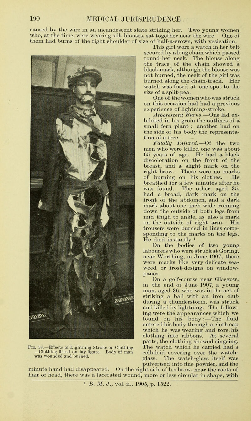 caused by the wire in an incandescent state striking her. Two young women who, at the time, were wearing silk blouses, sat together near the wire. One of them had burns of the right shoulder of size of half-a-crown, with vesication. This girl wore a watch in her belt secured by a long chain which passed round her neck. The blouse along the trace of the chain showed a black mark, although the blouse was not bmned, the neck of the girl was burned along the chain-track. Her watch was fused at one spot to the size of a split-pea. One of the women who was struck on this occasion had had a previous experience of lightning-stroke. Arborescent Burns.—One lad ex- hibited in his groin the outlines of a small fern plant ; another had on the side of his body the representa- tion of a tree. Fatally Injured.—Of the two men who were killed one was about 65 years of age. He had a black discoloration on the front of the breast, and a slight mark on the right brow. There were no marks of burning on his clothes. He breathed for a few minutes after he was found. The other, aged 35, had a broad, dark mark on the front of the abdomen, and a dark mark about one inch wide running down the outside of both legs from mid thigh to ankle, as also a mark on the outside of right arm. His trousers were burned in lines corre- sponding to the marks on the legs. He died instantly. ^ On the bodies of two young labourers who were struck at Goring, near Worthing, in June 1907, there were maiks like very delicate sea- weed or frost-designs on window- panes. On a golf-course near Glasgow, in the end of June 1907, a young man, aged 36, who was in the act of striking a ball with an iron club during a thunderstorm, was struck and killed by lightning. The follow- ing were the appearances which we found on his body:—The fluid entered his body through a cloth cap which he was wearing and tore, his clothing into ribbons. At several parts, the clothing showed singeing. The watch which he carried had a celluloid covering over the watch- glass. The watch-glass itself was pulverised into fine powder, and the minute hand had disappeared. On the right side of his brow, near the roots of hair of head, there was a lacerated wound, more or less circular in shape, with 1 B. M. J., vol. ii., 1905, p. 1522. Fig. 38.—Effects of Lightning-Stroke on Clothing —Clothing fitted on lay figure. Body of man was wounded and burned.