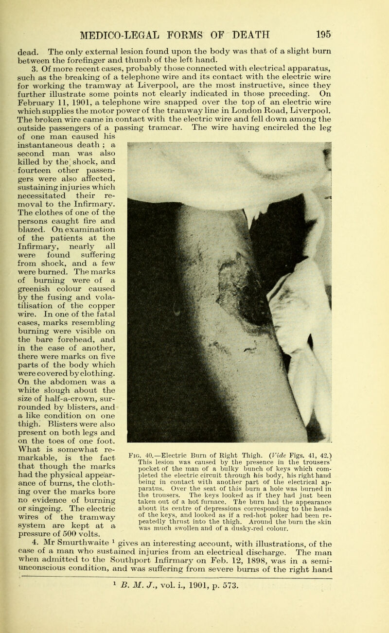 dead. The only external lesion found upon the body was that of a slight burn between the forefinger and thumb of the left hand. 3. Of more recent cases, probably those connected with electrical apparatus, such as the breaking of a telephone wire and its contact with the electric wire for working the tramway at Liverpool, are the most instructive, since they further illustrate some points not clearly indicated in those preceding. On February 11, 1901, a telephone wire snapped over the top of an electric wire which supplies the motor power of the tramway line in London Road, Liverpool. The broken wire came in contact with the electric wire and fell down among the outside passengers of a passing tramcar. The wire having encircled the leg of one man caused his instantaneous death ; a second man was also killed by the] shock, and fourteen other passen- gers were also affected, sustaining injuries which necessitated their re- moval to the Infirmary. The clothes of one of the persons caught fire and blazed. On examination of the patients at the Infirmary, nearly all were found suffering from shock, and a few were burned. The marks of biu'ning were of a greenish colour caused by the fusing and vola- tilisation of the copper wire. In one of the fatal cases, marks resembling burning were visible on the bare forehead, and in the case of another, there were marks on five parts of the body which were covered by clothing. On the abdomen was a white slough about the size of half-a-crown, sur- rounded by blisters, and a like condition on one thigh i Blisters were also present on both legs and on the toes of one foot. What is somewhat re- markable, is the fact that though the marks had the physical appear- ance of burns, the cloth- ing over the marks bore no evidence of burning or singeing. The electric wires of the tramway system are kept at a pressure of 500 volts. 4. Mr Smurthwaite ^ gives an interesting accovmt, with illustrations, of the case of a man who sustained injuries from an electrical discharge. The man when admitted to the Southport Infirmary on Feb. 12, 1898, was in a semi- unconscious condition, and was suffering from severe burns of the right hand Fig. 40.—Electric Burn of Right Thigh. (Vide Figs. 41, 42.) This lesion was caused by the presence in the trousers' pocket of the man of a bulky bunch of keys which com- pleted the electric circuit through his body, his right hand Yjeing in contact with another part of the electrical ap- paratus. Over the seat of this burn a hole was burned in the trousers. The keys looked as if they had just been taken out of a hot furnace. The burn had the appearance about its centre of depressions corresponding to the heads of the keys, and looked as if a red-hot poker had been re- peatedly thrust into the thigh. Around the burn the skin was much swollen and of a dusky-red colour.