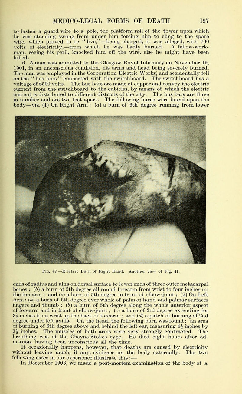 to fasten a guard wire to a pole, the platform rail of the tower upon which he was standing swung from under him forcing him to cling to the spare wire, which proved to be  live,—being charged, it was alleged, with 700 volts of electricity,—from which he was badly biirned. A fellow-work- man, seeing his peril, knocked him off the wire, else he might have been killed. 6. A man was admitted to the Glasgow Royal Infirmary on November 19, 1901, in an unconscious condition, his arms and head being severely burned. The man was employed in the Corporation Electric Works^ and accidentally fell on the bus bars connected with the switchboard. The switchboard has a voltage of 6500 volts. The bus bars are made of copper and convey the electric current from the switchboard to the cubicles, by means of which the electric current is distributed to different districts of the city. The bus bars are three in number and are two feet apart. The following burns were found upon the body—viz. (1) On Right Arm : (a) a burn of 6th degree running from lower Fig. 42.—Electric Burn of Right Hand. Another view of Fig. 41. ends of radius and ulna on dorsal surface to lower ends of three outer metacarpal bones ; (&) a burn of 5th degree all round forearm from wrist to four inches up the forearm ; and (c) a burn of 5th degree in front of elbow-joint ; (2) On Left Arm : (a) a burn of 6th degree over whole of palm of hand and palmar surfaces fingers and thumb ; (&) a burn of 5th degree along the whole anterior aspect of forearm and in front of elbow-joint ; (c) a burn of 3rd degree extending for 31 inches from wrist up the back of forearm ; and {d) a patch of burning of 2nd degree under left axilla. On the head, the following burn was found : an area of burning of 6th degree above and behind the left ear, measuring 4:h inches by 3| inches. The muscles of both arms were very strongly contracted. The breathing was of the Cheyne-Stokes type. He died eight hours after ad- mission, having been unconscious all the time. It occasionally happens, however, that deaths are caused by electricity without leaving much, if any, evidence on the body externally. The two following cases in our experience illustrate this :— In December 1906, we made a post-mortem examination of the body of