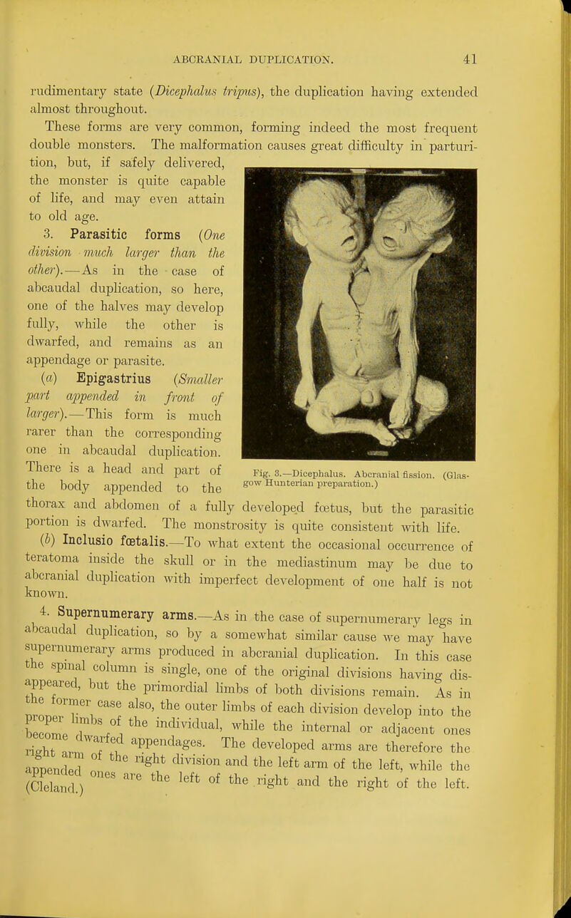 rudimentaiy state {Dicephalus tripus), the duplication having extended almost throughout. These forms are very common, forming indeed the most frequent double monsters. The malformation causes great difficulty in parturi- tion, but, if safely delivered, the monster is quite capable of life, and may even attain to old age. 3. Parasitic forms {One division much larger than the other).—As in the case of abcaudal duplication, so here, one of the halves may develop fully, while the other is dwarfed, and remains as an appendage or parasite. {a) Epigastrius (Smaller part appended in front of larger).—This form is much rarer than the corresponding one in abcaudal duplication. There is a head and part of the body appended to the thorax and abdomen of a fully developed foetus, but the parasitic portion is dwarfed. The monstrosity is quite consistent with life. (b) Inclusio foetalis.—To what extent the occasional occurrence of teratoma inside the skull or in the mediastinum may be due to abcranial duplication with imperfect development of one half is not known. 4. Supernumerary arms.—As in the case of supernumerary legs in abcaudal duplication, so by a somewhat similar cause we may have supernumerary arms produced in abcranial duplication. In this case the spmal column is single, one of the original divisions having dis- appeared, but the primordial limbs of both divisions remain. As in tne former case also, the outer limbs of each division develop into the become r .'V^' individual. Mobile the internal or adjacent ones ZTartl :i ^PP^'^^^^g^^- The developed arms are therefore the appended '^^^ ^™ «f left, while the (K 1 gh^ the right of the left. Fig- 3.—Dicephalus. Abcranial fission. (Glas- gow Huuterian preparation.)