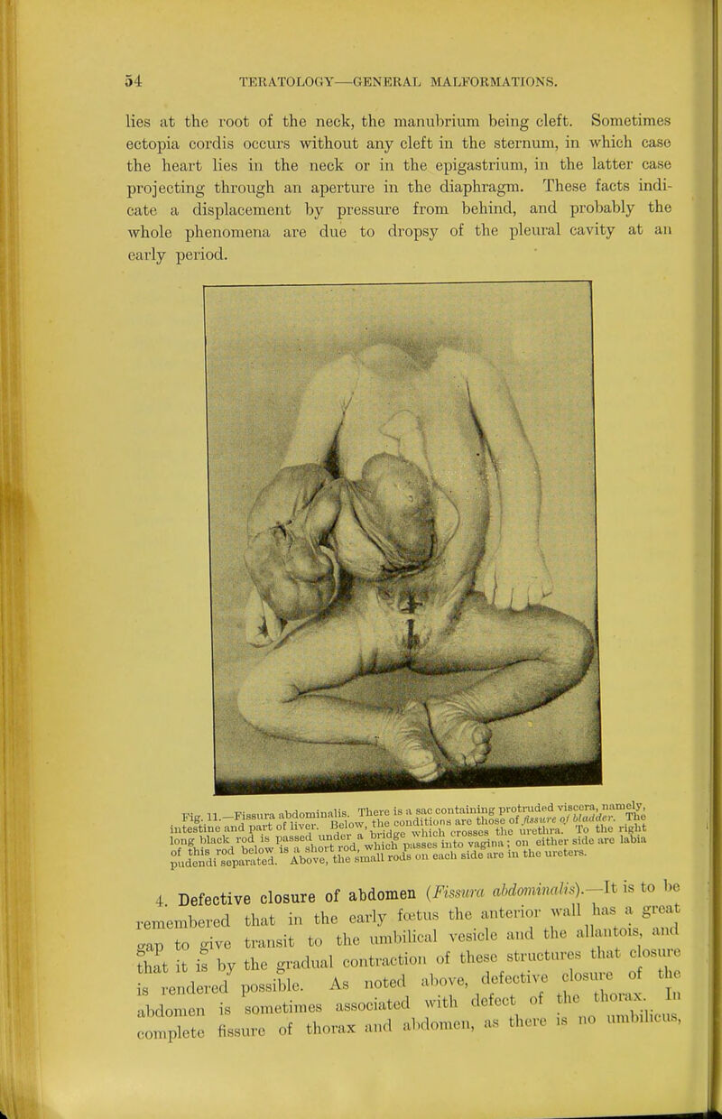 lies at the root of the neck, the manubrium being cleft. Sometimes ectopia cordis occurs without any cleft in the sternum, in which case the heart lies in the neck or in the epigastrium, in the latter case projecting through an aperture in the diaphragm. These facts indi- cate a displacement by pressure from behind, and probably the whole phenomena are due to dropsy of the pleural cavity at an early period. 4 Defective closure of abdomen {Fissura ahdmiimlis)-It is to be remembered that in the early fcetus the anterior wall has a great gap to give transit to the umbilical vesicle and the allantois and IZt it iS by the gradual contractior. of these structures that c osure L rendered'possiHe. As noted above, defectn-e d^^^^^^^^^ t abdomen is sometimes associated with defect of the thoiax. In :omplI fissure of thorax and abdomen, as there is no umb.hcus.