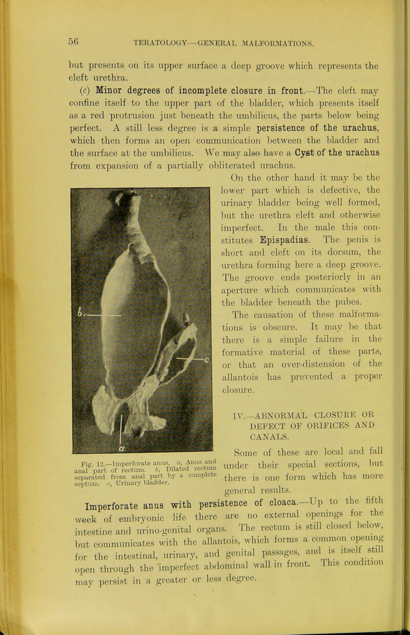 but preseuts on its upper surface a deep groove which represents the cleft urethra. (c) Minor degrees of incomplete closure in front.—The cleft may confine itself to the upper part of the bladder, which presents itself as a red protrusion just beneath the umbilicus, the parts below being perfect. A still less degree is a simple persistence of the urachus, which then forms an open communication Ijetween the liladder and the surface at the umbilicus. We may also have a Cyst of the urachus from expansion of a partially obliterated \irachus. On the other hand it may be the lower part which is defectiA's, the urinary bladder being well formed, but the urethra cleft and othermse imperfect. In the male this con- stitutes Epispadias. The penis is short and cleft on its dorsum, the urethra forming here a deep groove. The groove ends posteriorly in an aperture which communicates -svith the bladder beneath the pubes. The causation of these malforma- tions is obscure. It may be that there is a simple failure in the formative material of these parts, or that an over-distension of the allantois has prevented a proper closure. IV.—ABNORMAL CLOSURE OR DEFECT OF ORIFICES AND CANALS. Some of these are local and fall ^■^^:^T^^^<^ ^ider their special sections, but separated from anal part by a complete jg ^j^g iovm which haS mOrC .septum, c, Urinary bladder. general results. Imperforate anus with persistence of cloaca.-Up to the fifth week of embryonic life there are no external openings for the intestine and urino-genital organs. The rectum is still closed below, but communicates with the allantoi-s, which forms a common opening for the intestinal, urinary, and genital passages, and is itself still open through the imperfect abdominal wall in front. This condition may persist in a greater or less degree.