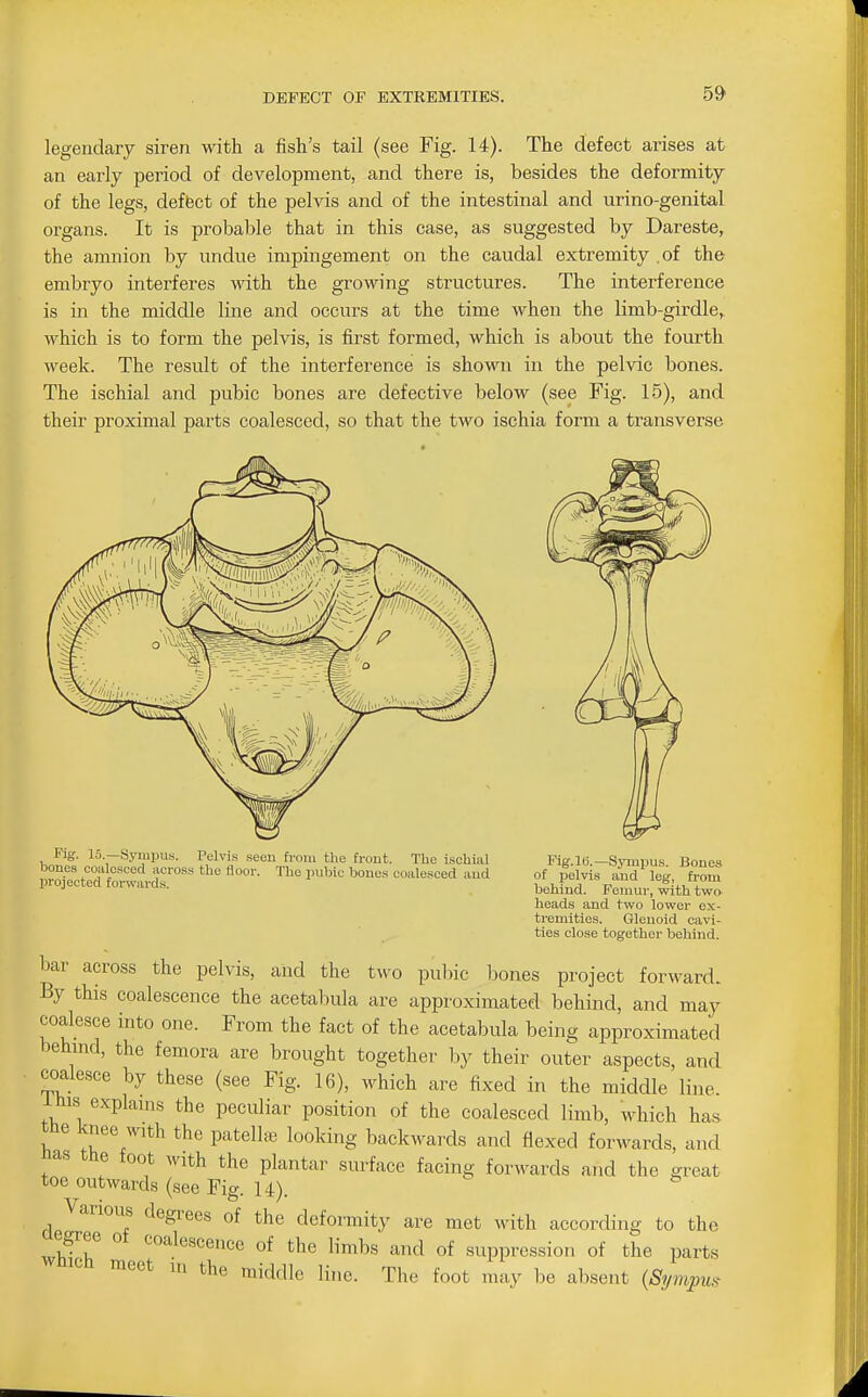 legendary siren with a fish's tail (see Fig. 14). The defect arises at an early period of development, and there is, besides the deformity of the legs, deffect of the pelvis and of the intestinal and urino-genital organs. It is probable that in this case, as suggested by Dareste, the amnion by undue impingement on the caudal extremity .of the embryo interferes with the growing structures. The interference is in the middle line and occurs at the time when the limb-girdle, which is to form the pelvis, is first formed, which is about the fourth week. The result of the interference is shown in the pelvic bones. The ischial and pubic bones are defective below (see Fig. 15), and their proximal parts coalesced, so that the two ischia form a transverse Fig. 15 —Syiupus. Pelvis seen from the front. The ischial Fig.16.—Svmpus Bones ^rSp' rf°''°<^ f tl^« «~'-- The pubie bone.s coalesced and of pelvis and' eg, from projected forwards. _ behind. Femur, with tw» heads and two lower ex- tremities. Glenoid cavi- ties close together behind. bar across the pelvis, and the two pul^ic bones project forward. By this coalescence the acetabula are approximated behind, and may coalesce into one. From the fact of the acetabula being approximated behind, the femora are brought together by their outer aspects, and coalesce by these (see Fig. 16), which are fixed in the middle line, i his explains the peculiar position of the coalesced limb, which has. the knee with the patelte looking backwards and flexed forwards, and nas the foot with the plantar surface facing forwards and the great toe outwards (see Fig. U). Various degrees of the deformity are met with according to the egree ot coalescence of the limbs and of suppression of the parts wmch meet in the middle line. The foot may be absent (Sympm