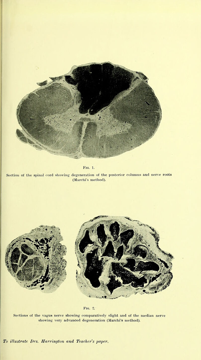 Fig. 1. Section of tlie spinal cord showinjf degeneration of the posterior columns and nerve roots (Marchi's method). Fiu. 2. Sections of the vagus nerve showing comparatively slight and of the median nerve showing very advanced degeneration (Marchi's method). To illustrate Drs, Harrington and Teacher's paper,