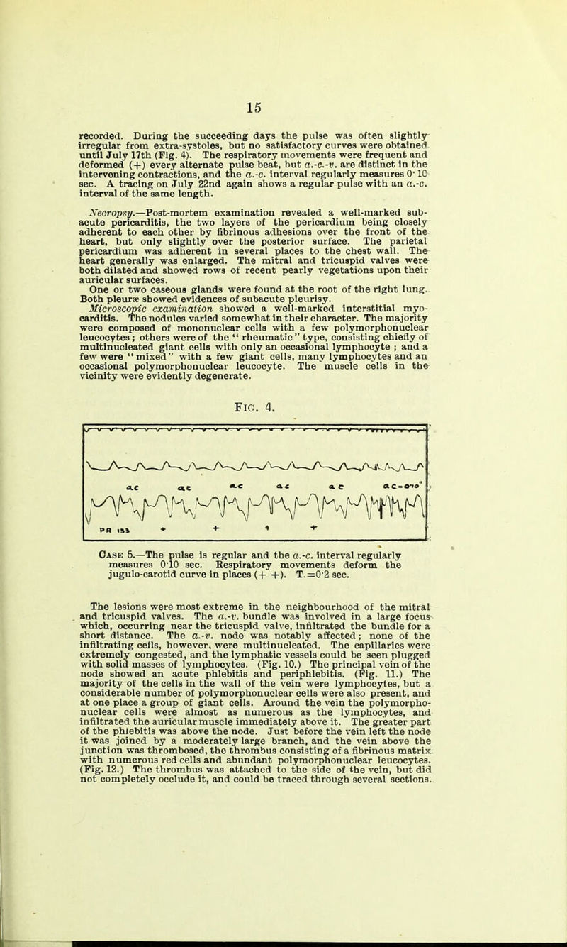 recorded. Daring the succeeding days the pulse was often slightly- irregular from extra-systoles, but no satisfactory curves were obtained, until July 17th (Fig. 4). The respiratory movements were frequent and deformed (+) every alternate pulse beat, but a.-c.-v. are distinct in the intervening contractions, and the a.-c. interval regularly measures 0' 10 sec. A tracing on July 22nd again shows a regular pulse with an a.-c. interval of the same length. Necropsy.—Post-mortem examination revealed a well-marked sub- acute pericarditis, the two layers of the pericardium being closely adherent to each other by fibrinous adhesions over the front of the heart, but only slightly over the posterior surface. The parietal pericardium was adherent in several places to the chest wall. The heart generally was enlarged. The mitral and tricuspid valves were both dilated and showed rows of recent pearly vegetations upon their auricular surfaces. One or two caseous glands were found at the root of the right lung. Both pleurae showed evidences of subacute pleurisy. Microscopic examination showed a well-marked interstitial myo- carditis. The nodules varied somewhat in their character. The majority were composed of mononuclear cells with a few polymorphonuclear leucocytes ; others were of the  rheumatic type, consisting chiefly of multinucleated giant cells with only an occasional lymphocyte ; and a few were mixed with a few giant cells, many lymphocytes and an occasional polymorphonuclear leucocyte. The muscle cells in thfr vicinity were evidently degenerate. Fig. 4. ai^Q dC w«• (A ^ WiW'w'v Case 5.—The pulse is regular and the ct.-e. interval regularly measures 010 sec. Respiratory movements deform the jugulo-carotid curve in places (-1- +). T.=0 2 sec. The lesions were most extreme in the neighbourhood of the mitral and tricuspid valves. The a.-v. bundle was involved in a large focus which, occurring near the tricuspid valve, infiltrated the bundle for a short distance. The a.-v. node was notably affected; none of the infiltrating cells, however, were multinucleated. The capillaries were extremely congested, and the lymphatic vessels could be seen plugged with solid masses of lymphocytes. (Fig. 10.) The principal vein of the node showed an acute phlebitis and periphlebitis. (Fig. 11.) The majority of the cells in the wall of the vein were lymphocytes, but a considerable number of polymorphonuclear cells were also present, and at one place a group of giant cells. Around the vein the polymorpho- nuclear cells were almost as numerous as the lymphocytes, and infiltrated the auricular muscle immediately above it. The greater part of the phlebitis was above the node. Just before the vein left the node it was joined by a moderately large branch, and the vein above the junction was thrombosed, the thrombus consisting of a fibrinous matrix with numerous red cells and abundant polymorphonuclear leucocytes. (Pig. 12.) The thrombus was attached to the side of the vein, but did not completely occlude it, and could be traced through several sections.