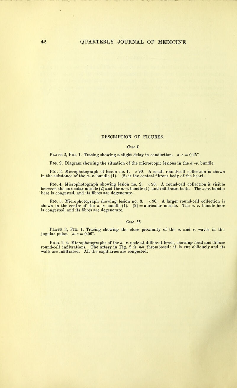 DESCRIPTION OF FIGURES. Case I. Plate 2, Fig. 1. Tracing showing a slight delay in conduction, a-c = 0-25. Pig. 2. Diagram showing the situation of the microscopic lesions in the a.-v. bundle. Fig. 3. Microphotograph of lesion no. 1. x 90. A small round-cell collection is shown in the substance of the a.-v. bundle (1). (2) is the central fibrous body of the heart. Fig. 4. Microphotograph showing lesion no. 2. x 90. A round-cell collection is visible between the auricular muscle (2) and the a.-v. bundle (1), and infiltrates both. The a.-v. bundle here is congested, and its fibres are degenerate. Fig. 5. Microphotograph showing lesion no. 3. x 90. A larger round-cell collection is shown in the centre of the a.-v. bundle (1). (2) = auricular muscle. The a.-v. bundle here is congested, and its fibres are degenerate. Case II. Plate 3, Fig. 1. Tracing showing the close proximity of the a. and v. waves in the jugular pulse. a~c = O-OB. Pigs. 2-4. Microphotographs of the a.-v. node at different levels, showing focal and diffuse round-cell infiltrations. The artery in Fig. 2 is not thrombosed: it is cut obliquely and its walls are infiltmted. All the capillaries are congested.