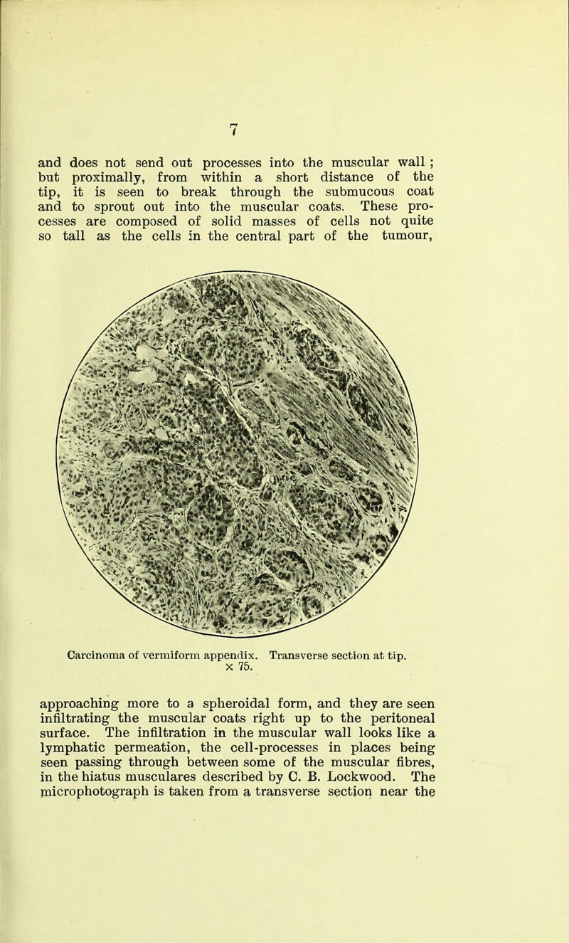 and does not send out processes into the muscular wall; but proximally, from within a short distance of the tip, it is seen to break through the submucous coat and to sprout out into the muscular coats. These pro- cesses are composed of solid masses of cells not quite so tall as the cells in the central part of the tumour, Carcinoma of vermiform appendix. Transverse section at tip. X 75. approaching more to a spheroidal form, and they are seen infiltrating the muscular coats right up to the peritoneal surface. The infiltration in the muscular wall looks like a lymphatic permeation, the cell-processes in places being seen passing through between some of the muscular fibres, in the hiatus musculares described by C. B. Lockwood. The paicrophotograph is taken from a transverse section near the