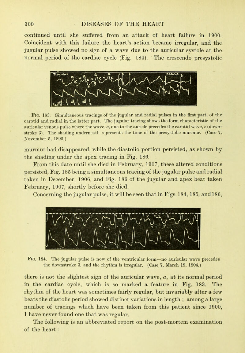 continued until she sujffered from an attack of heart failure in 1900. Coincident with this failure the heart's action became irregular, and the jugular pulse showed no sign of a wave due to the auricular systole at the normal period of the cardiac cycle (Fig. 184). The crescendo presystolic Fig. 183. Simultaneous tracings of the jugular and radial pulses in the first part, of the carotid and radial in the latter part. The jugular tracing shows the form characteristic of the auricular venous pulse where the wave, a, due to the auricle precedes the carotid wave, c (down- stroke 3). The shading underneath represents the time of the presystoUc murmur. (Case 7, November 5, 1895.) murmur had disappeared, while the diastolic portion persisted, as shown by the shading under the apex tracing in Fig. 186. From this date until she died in February, 1907, these altered conditions persisted, Fig. 185 being a simultaneous tracing of the jugular pulse and radial taken in December, 1906, and Fig. 186 of the jugular and apex beat taken February, 1907, shortly before she died. Concerning the jugular pulse, it will be seen that in Figs. 184, 185, and 186, Fig. 184. The jugular pulse is now of the ventricular form—no auricular wave precedes the do^vnstroke 3, and the rhythm is irregular. (Case 7, March 19, 1904.) there is not the slightest sign of the auricular wave, a, at its normal period in the cardiac cycle, Avhich is so marked a feature in Fig. 183. The rhythm of the heart was sometimes fairly regular, but invariably after a few beats the diastolic period showed distinct variations in length ; among a large number of tracings which have been taken from this patient since 1900, I have never found one that Avas regular. The following is an abbreviated report on the post-mortem examination of the heart:
