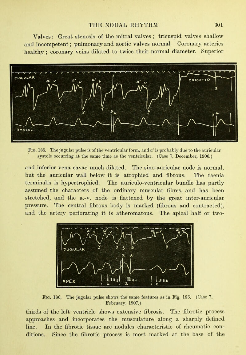 Valves: Great stenosis of the mitral valves ; tricuspid valves shallow and incompetent; pulmonary and aortic valves normal. Coronary arteries healthy ; coronary veins dilated to twice their normal diameter. Superior Fig. 185. The jugular pulse is of the ventricular form, and a' is probably due to the auricular systole occurring at the same time as the ventricular. (Case 7, December, 1906.) and inferior vena cavae much dilated. The sino-auricular node is normal, but the auricular wall below it is atrophied and fibrous. The taenia terminalis is hypertrophied. The auriculo-ventricular bundle has partly assumed the characters of the ordinary muscular fibres, and has been stretched, and the a.-v. node is flattened by the great inter-auricular pressure. The central fibrous body is marked (fibrous and contracted), and the artery perforating it is atheromatous. The apical half or two- FiG. 186. The jugular pulse shows the same features as in Fig. 185. (Case 7, February, 1907.) thirds of the left ventricle shows extensive fibrosis. The fibrotic process approaches and incorporates the musculature along a sharply defined line. In the fibrotic tissue are nodules characteristic of rheumatic con- ditions. Since the fibrotic process is most marked at the base of the