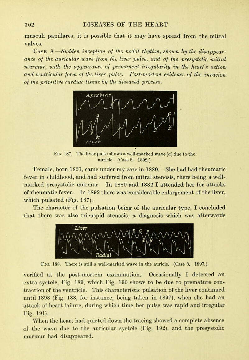 musculi papillares, it is possible that it may have spread from the mitral valves. Case 8.—Sudden ince'ption of the nodal rhythm, shown by the disappear- ance of the auricular wave from the liver pulse, and of the presystolic mitral murmur, with the appearance of permanent irregularity in the hearfs action and ventricular form of the liver pulse. Post-mortem evidence of the invasion of the primitive cardiac tissue by the diseased process. Fig. 187. The liver pulse shows a well-marked wave (a) due to the auricle. (Case 8. 1892.) Female, born 1851, came under my care in 1880. She had had rheumatic fever in childhood, and had suffered from mitral stenosis, there being a well- marked presystolic murmur. In 1880 and 1882 I attended her for attacks of rheumatic fever. In 1892 there was considerable enlargement of the liver, which pulsated (Fig. 187). The character of the pulsation being of the auricular type, I concluded that there was also tricuspid stenosis, a diagnosis which was afterwards Fig. 188. There is still a well-marked wave in the auricle. (Case 8. 1897.) verified at the post-mortem examination. Occasionally I detected an extra-systole, Fig. 189, which Fig. 190 shows to be due to premature con- traction of the ventricle. This characteristic pulsation of the liver continued until 1898 (Fig. 188, for instance, being taken in 1897), when she had an attack of heart failure, during Avliich time her pulse was rapid and irregular Fig. 191). When the heart had quieted down the tracing showed a complete absence of the wave due to the auricular systole (Fig. 192), and the presystoUc murmur had disappeared.